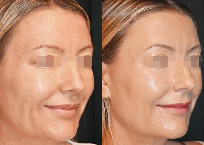 JULÄINE of Sweden before and after