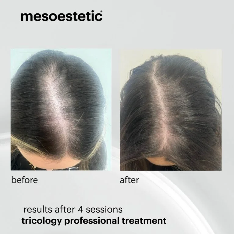 hair loss treatment