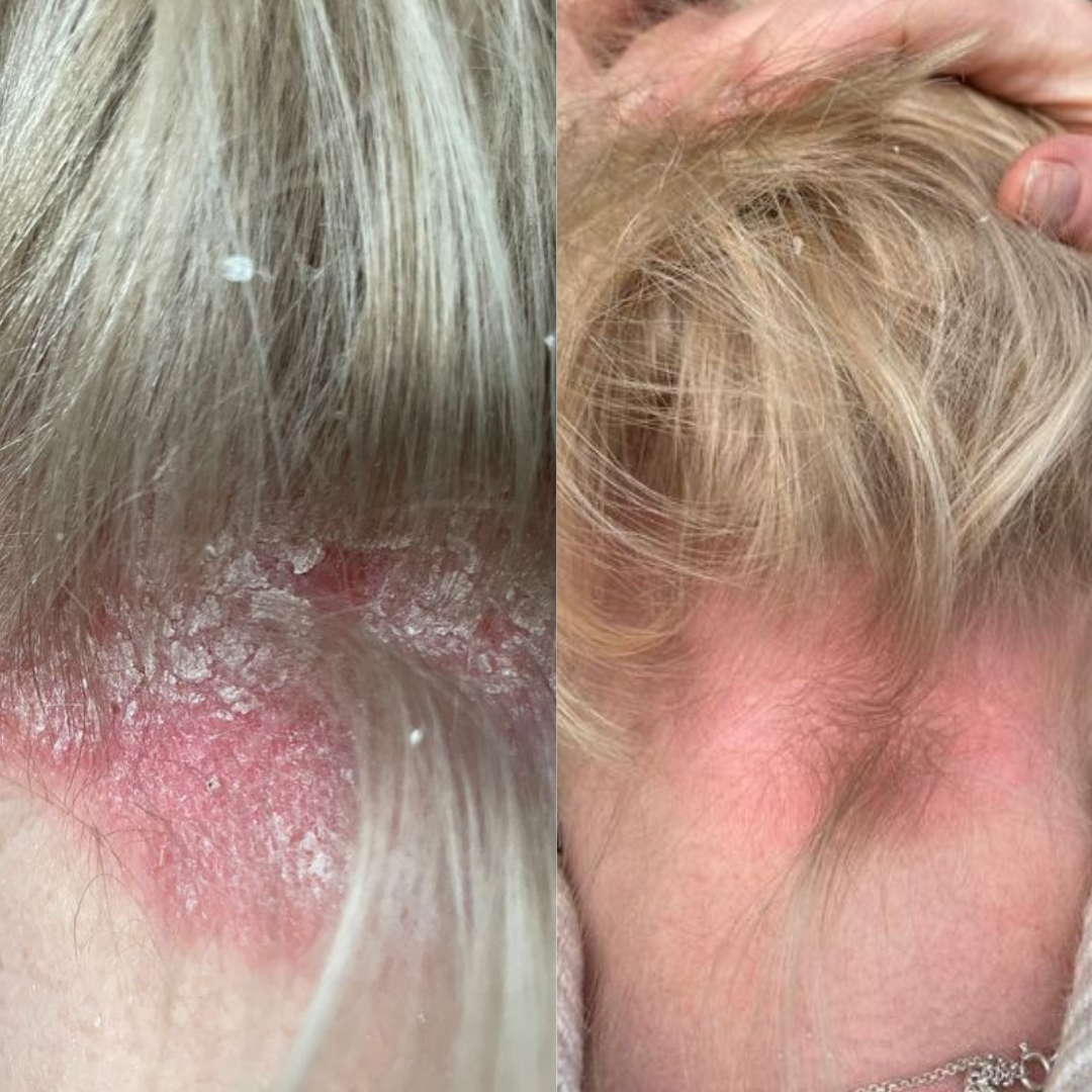 LED light therapy for scaly skin