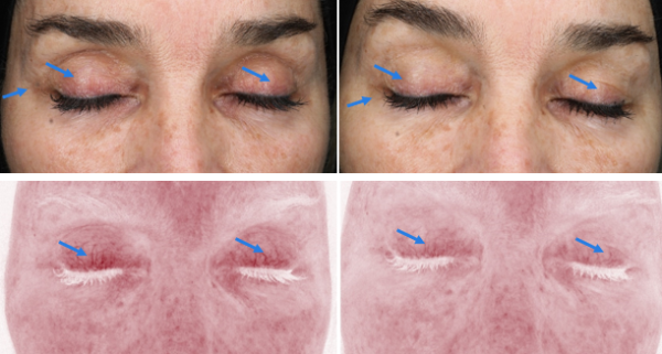 Chemical peel before and after