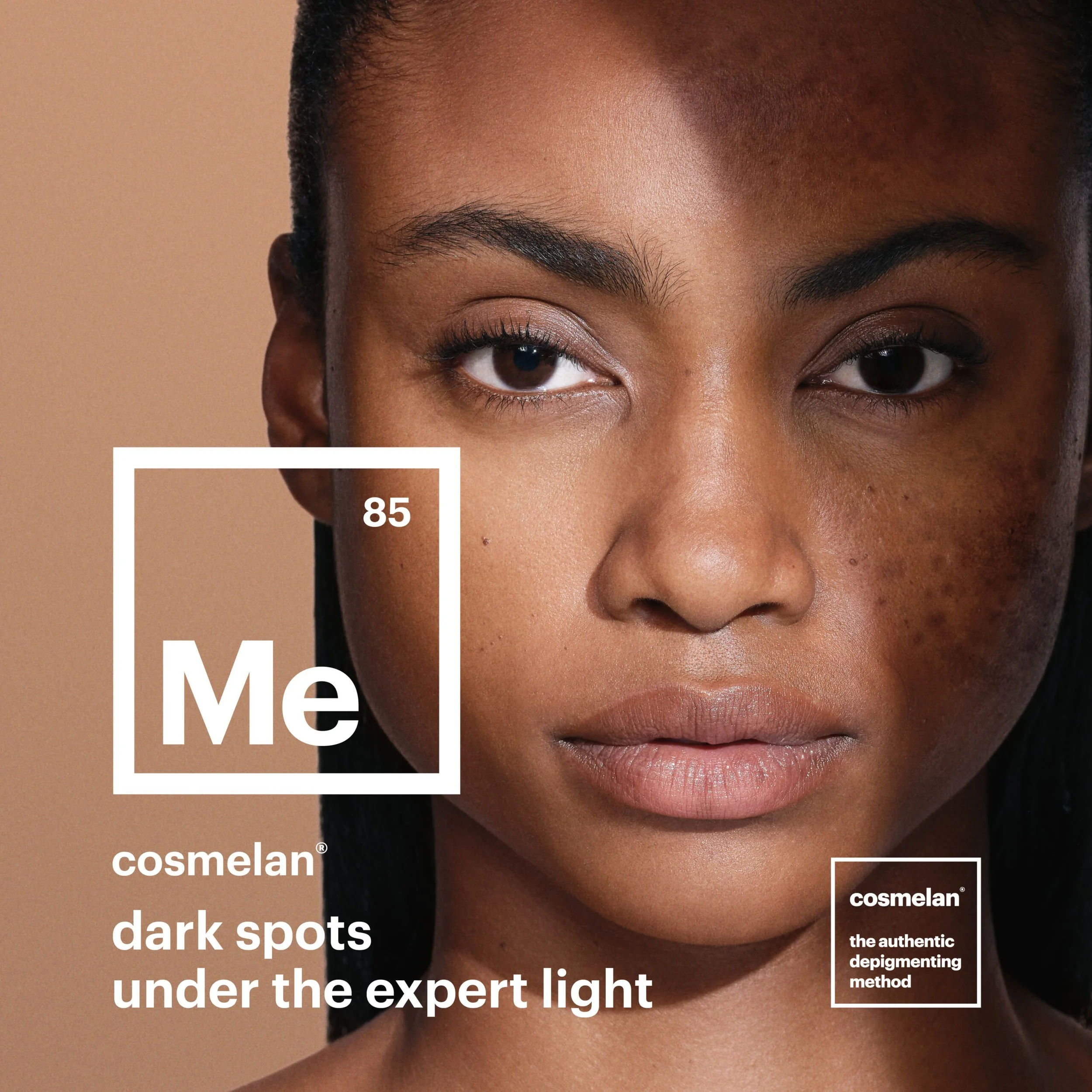 melasma treatment in london