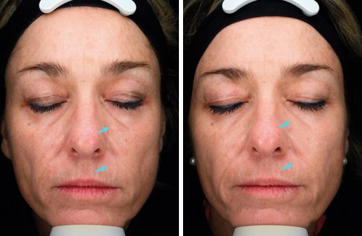 Chemical peel before and after