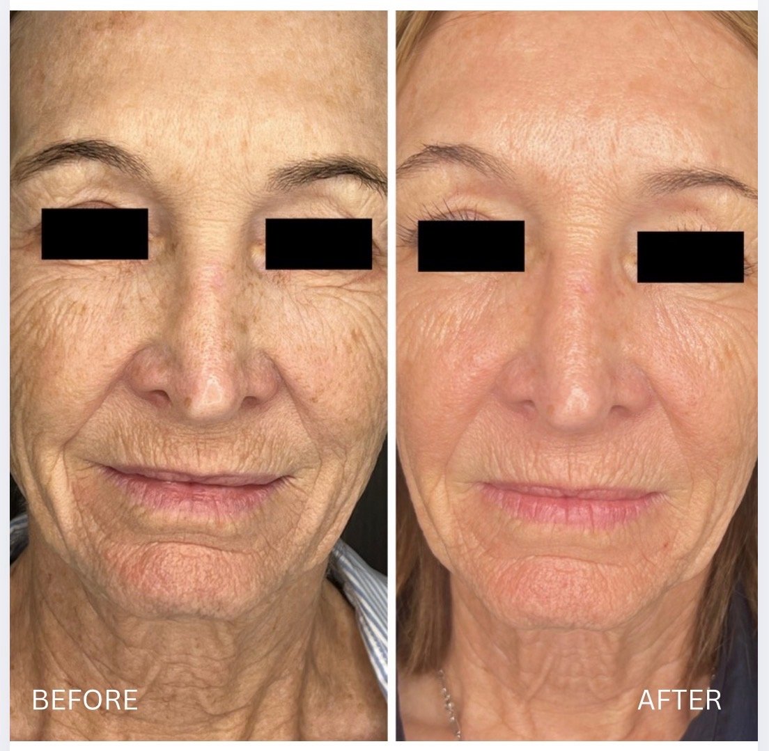 Dr. TIna Hakimian performed cool peel