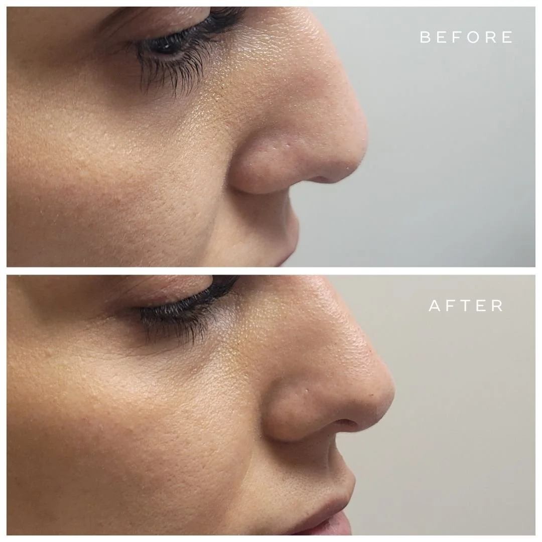 Non-surgical Nose Augmentation - UltraPlus