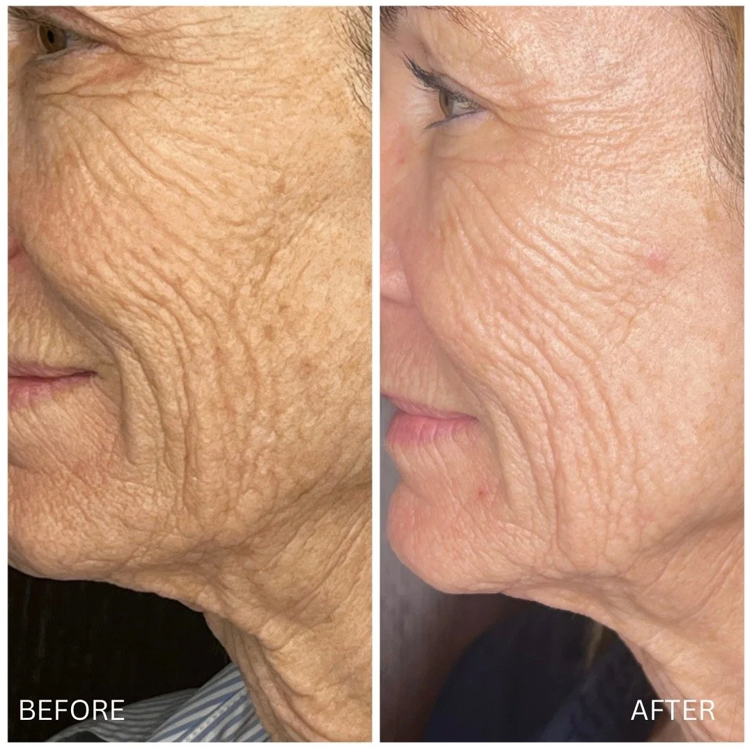 cool peel before and after