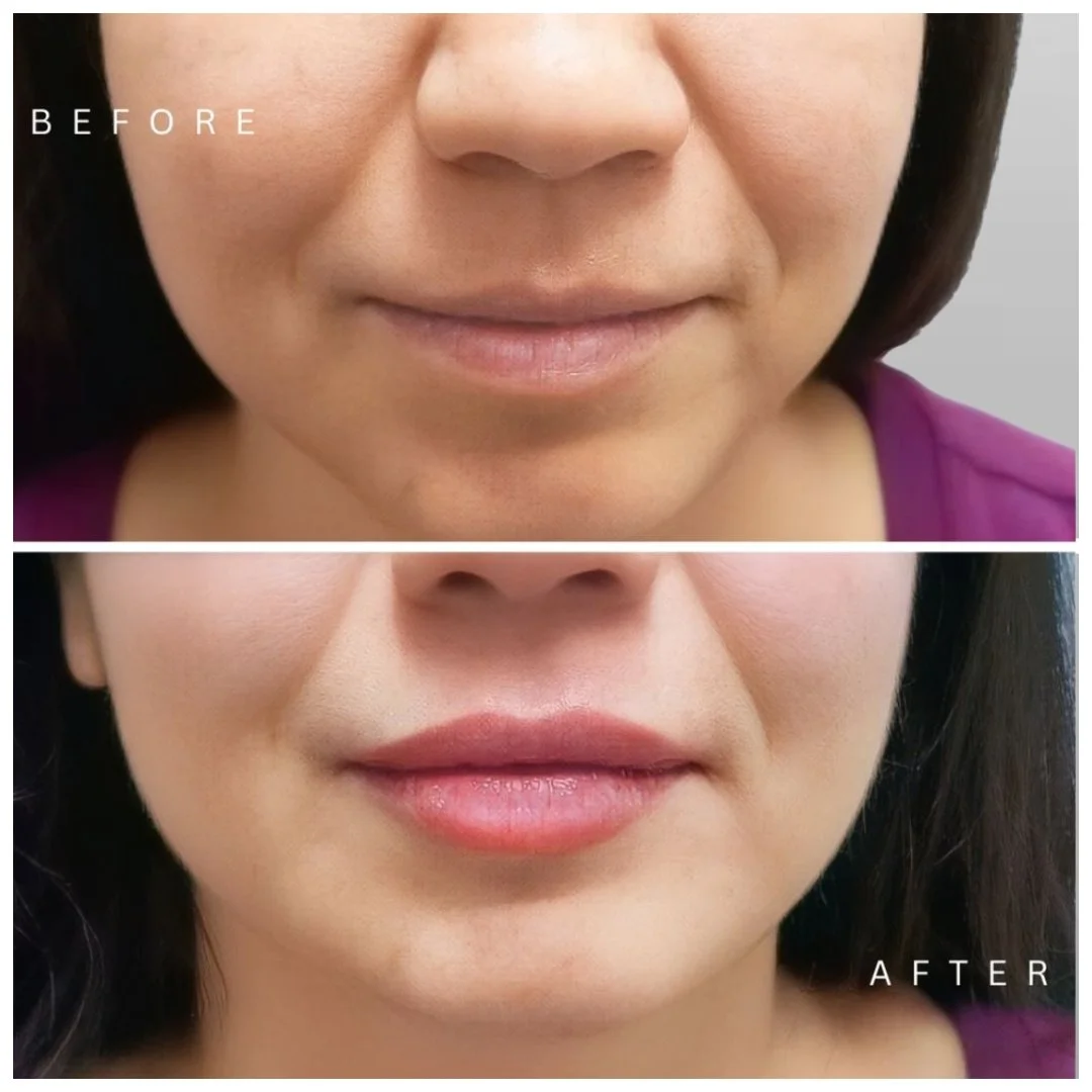 Lip Filler - Volbella