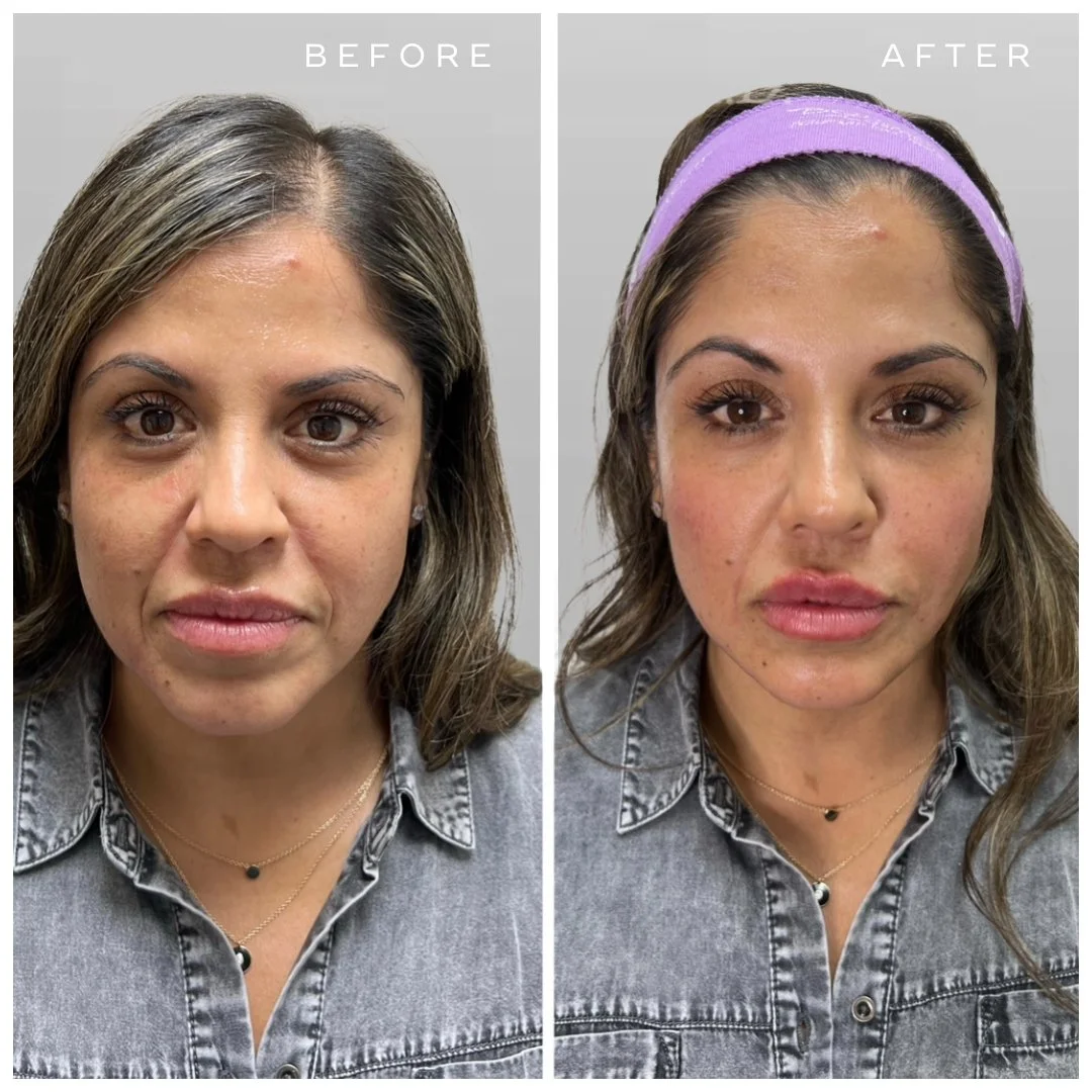 Facial Balancing Filler - Voluma, Volbella
