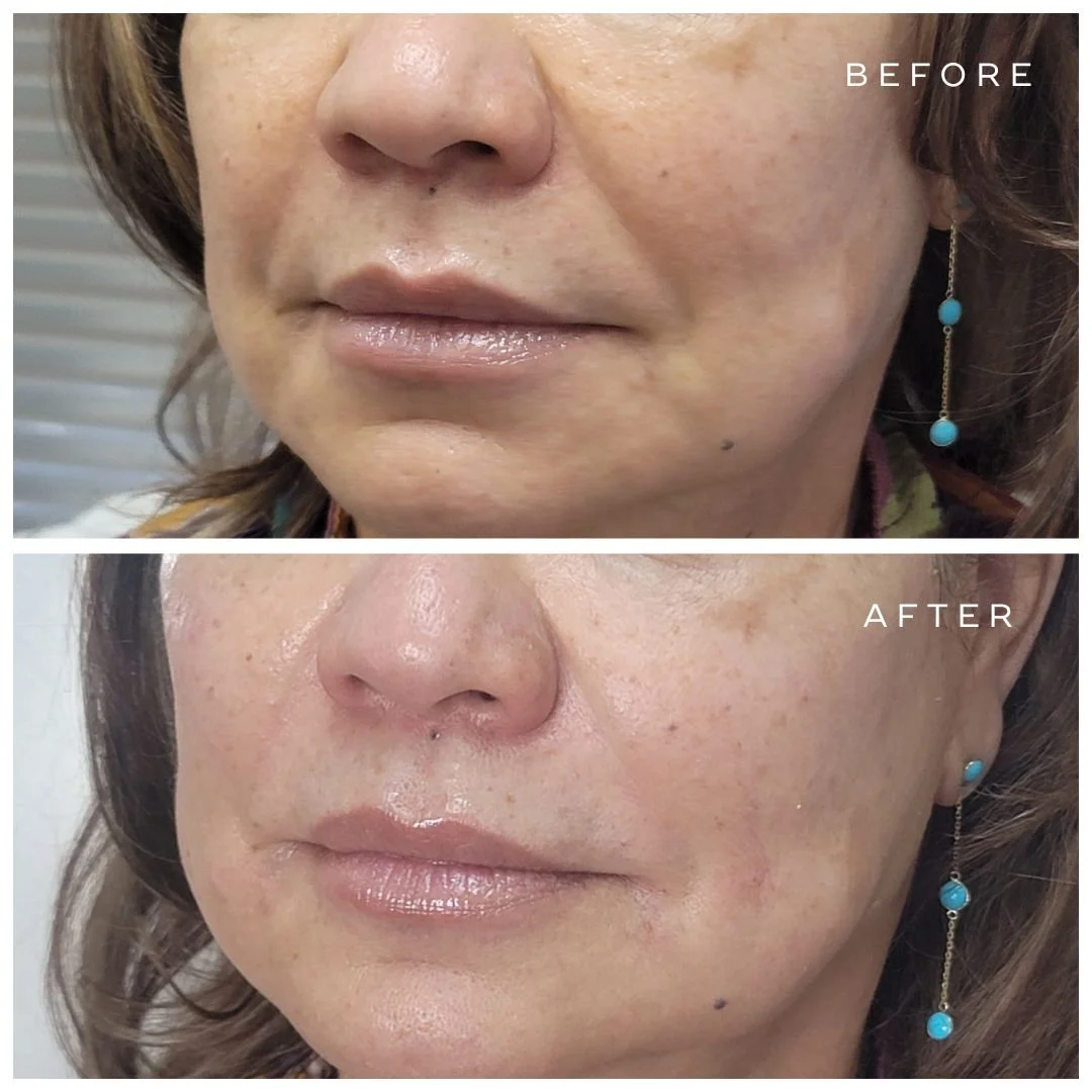 Nasolabial Fold - UltraPlus