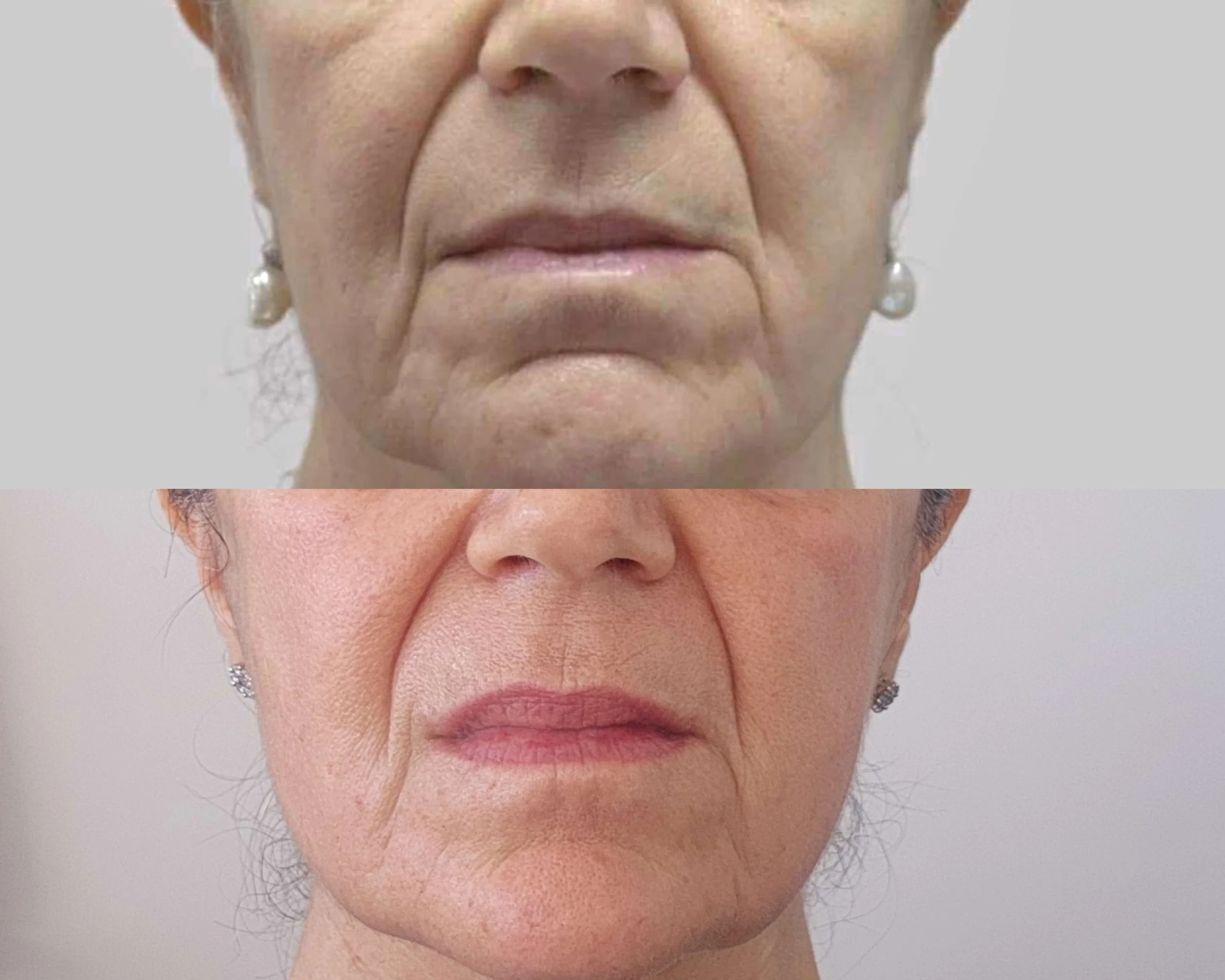 After 2 full face Hifu treatments