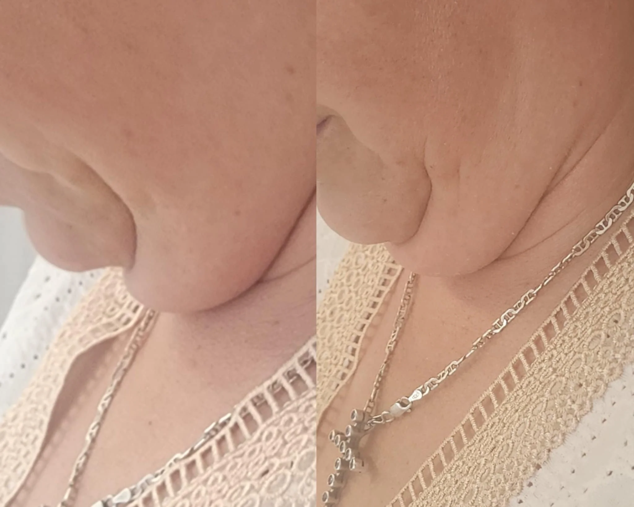 Liquid lipo necklift after 1 treatment