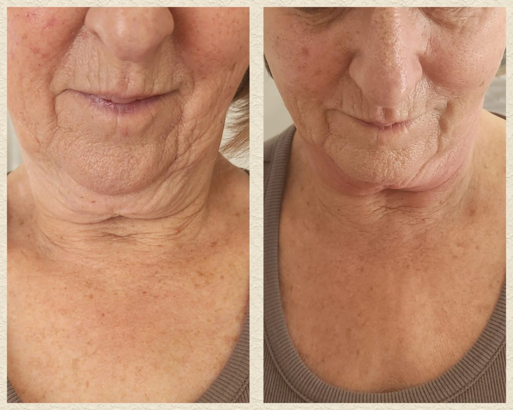 Liquid lipo necklift after 1 treatment