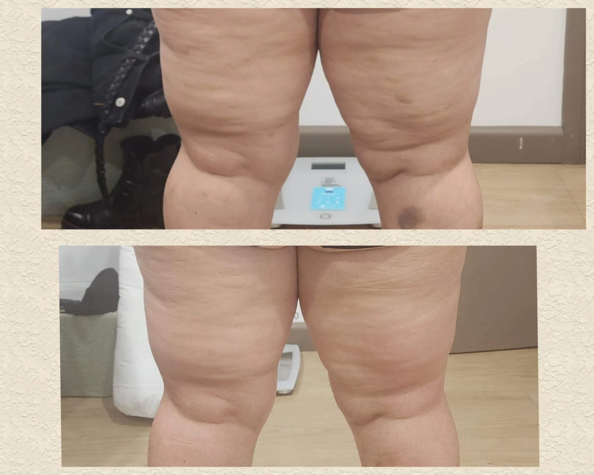 After 1 liquid lipo treatment including pressotherapy