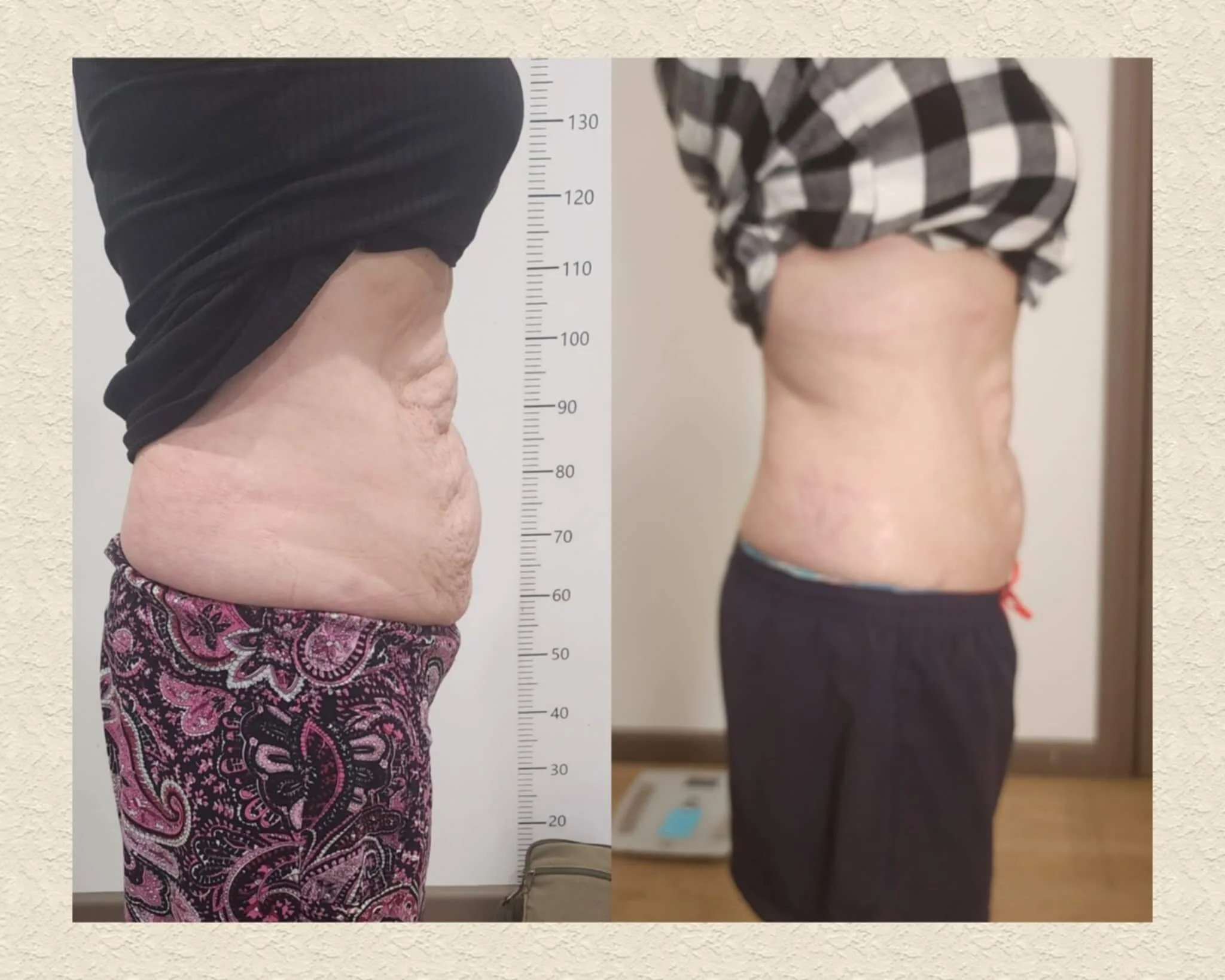 After 4 full tummy liquid lipo treatments