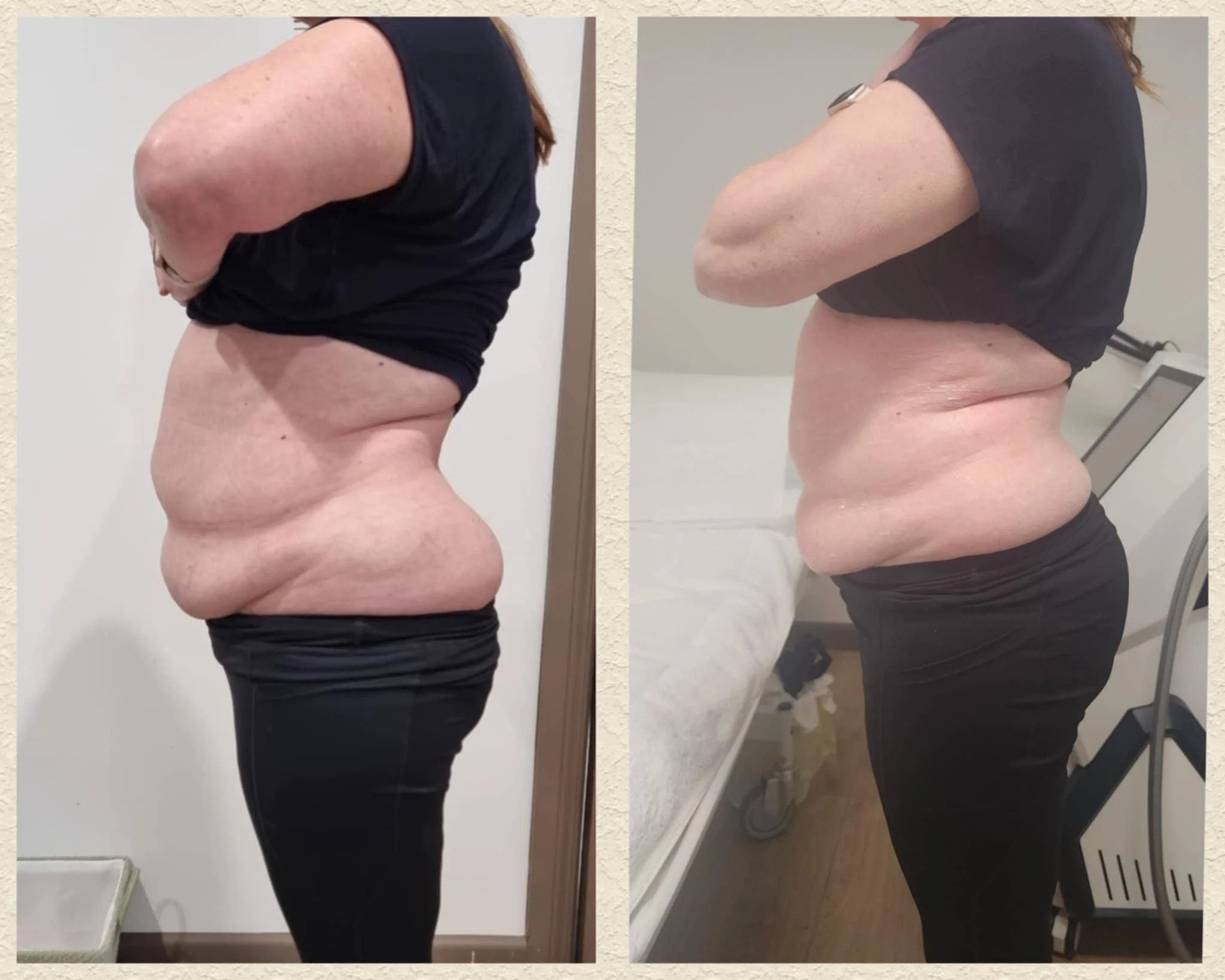 After 1 full tummy liquid lipo treatment
