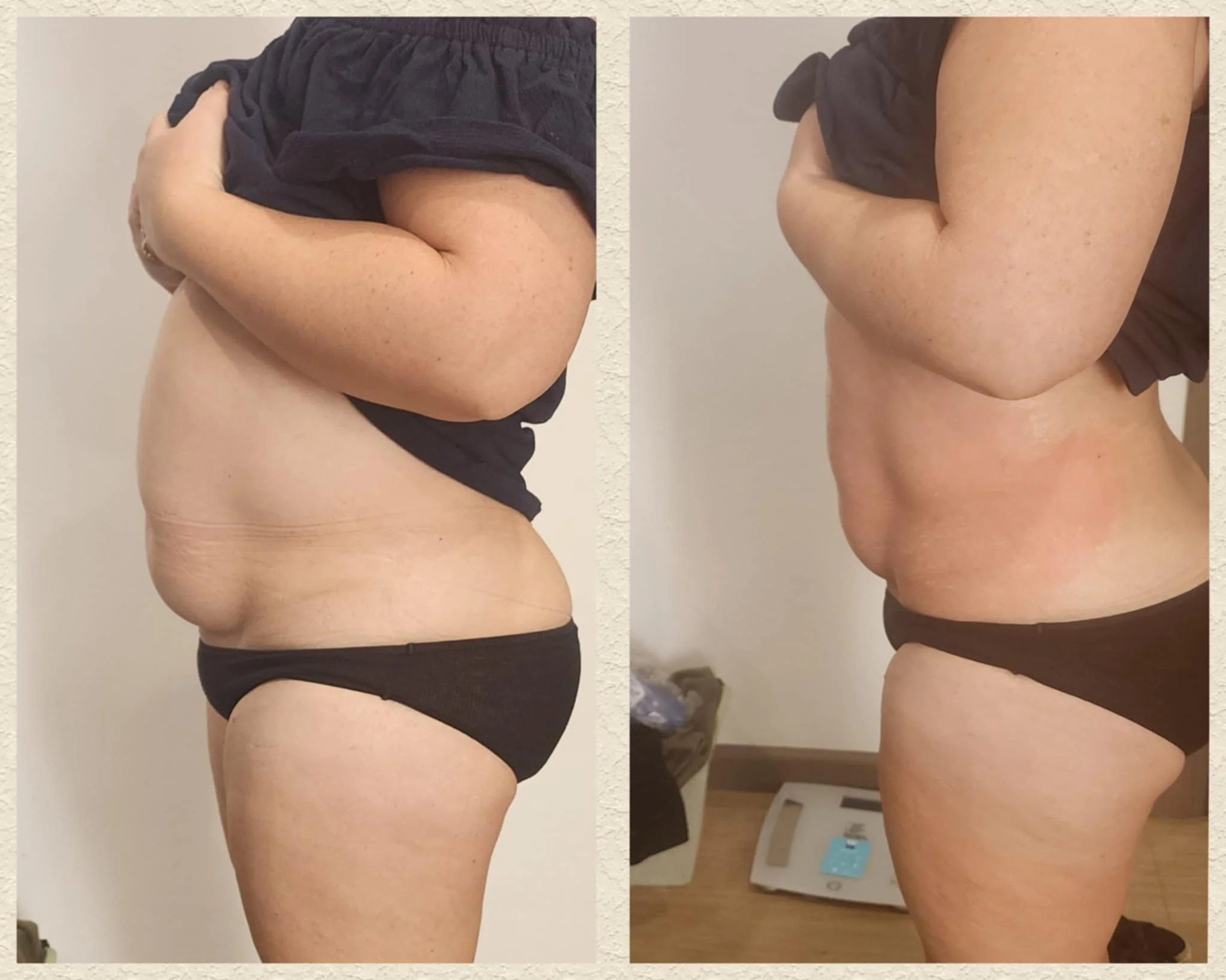 After 2 full tummy liquid lipo treatments