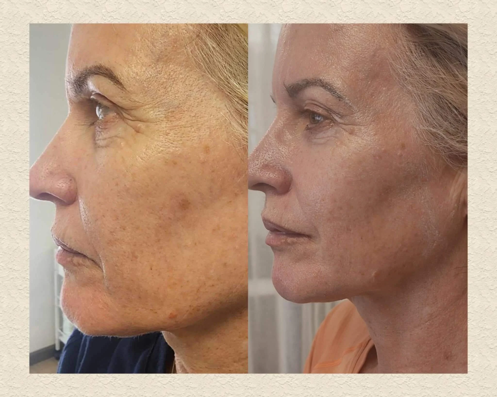 Full face fibroblast - fully healed.
