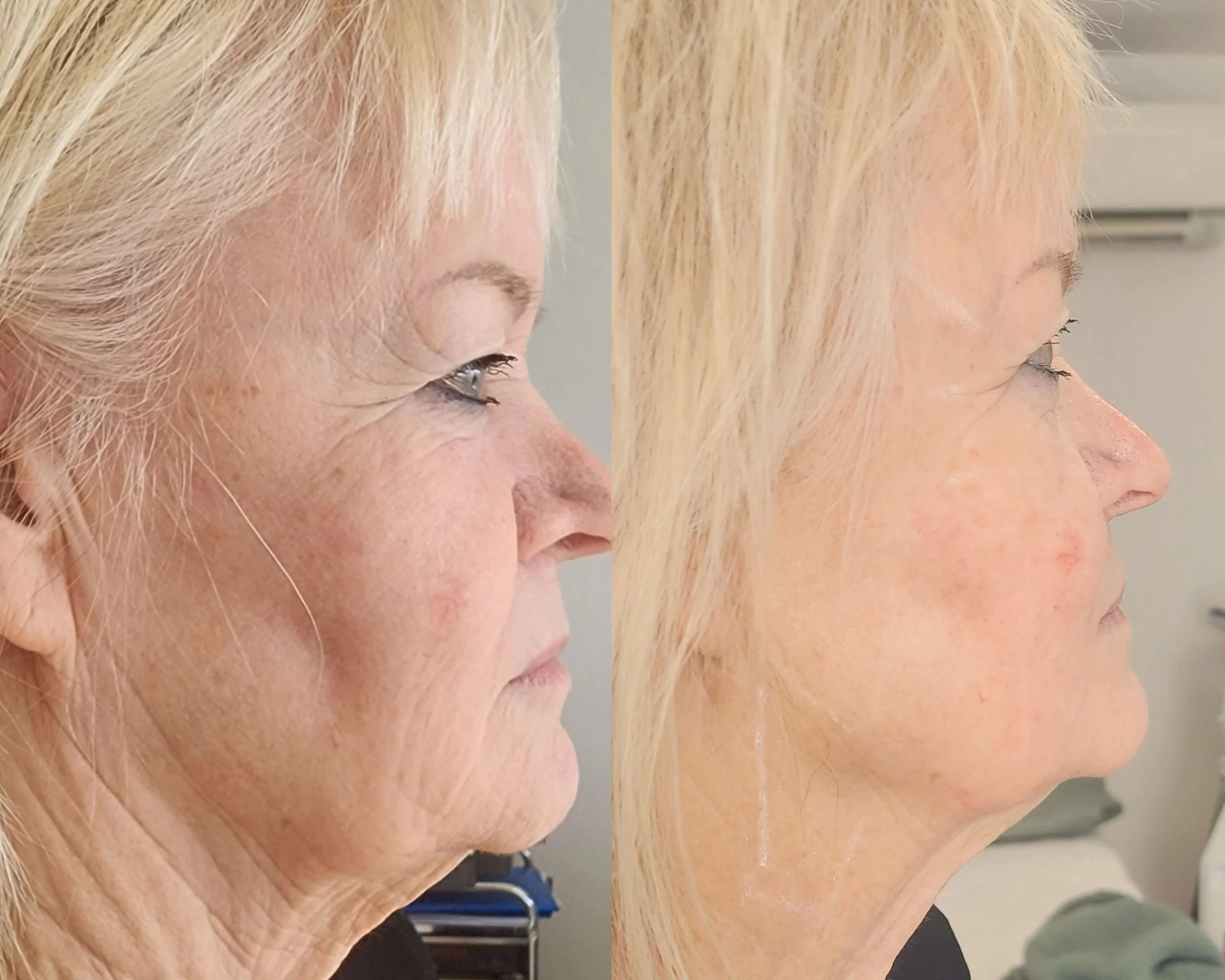 After 2 full face Hifu treatments