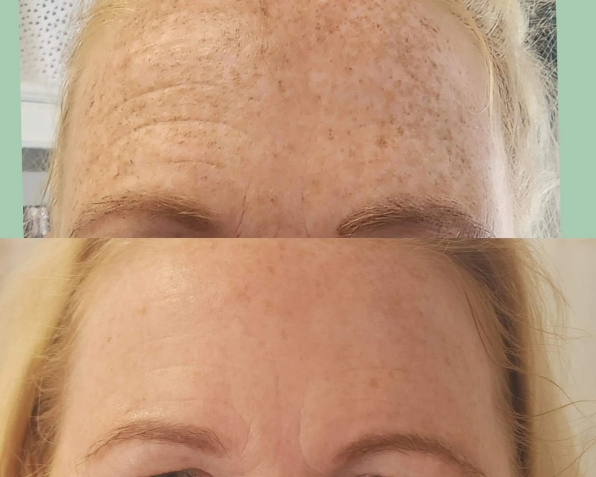 Forehead after 2 Fibroblast treatments - notice the change in pigmentation also.