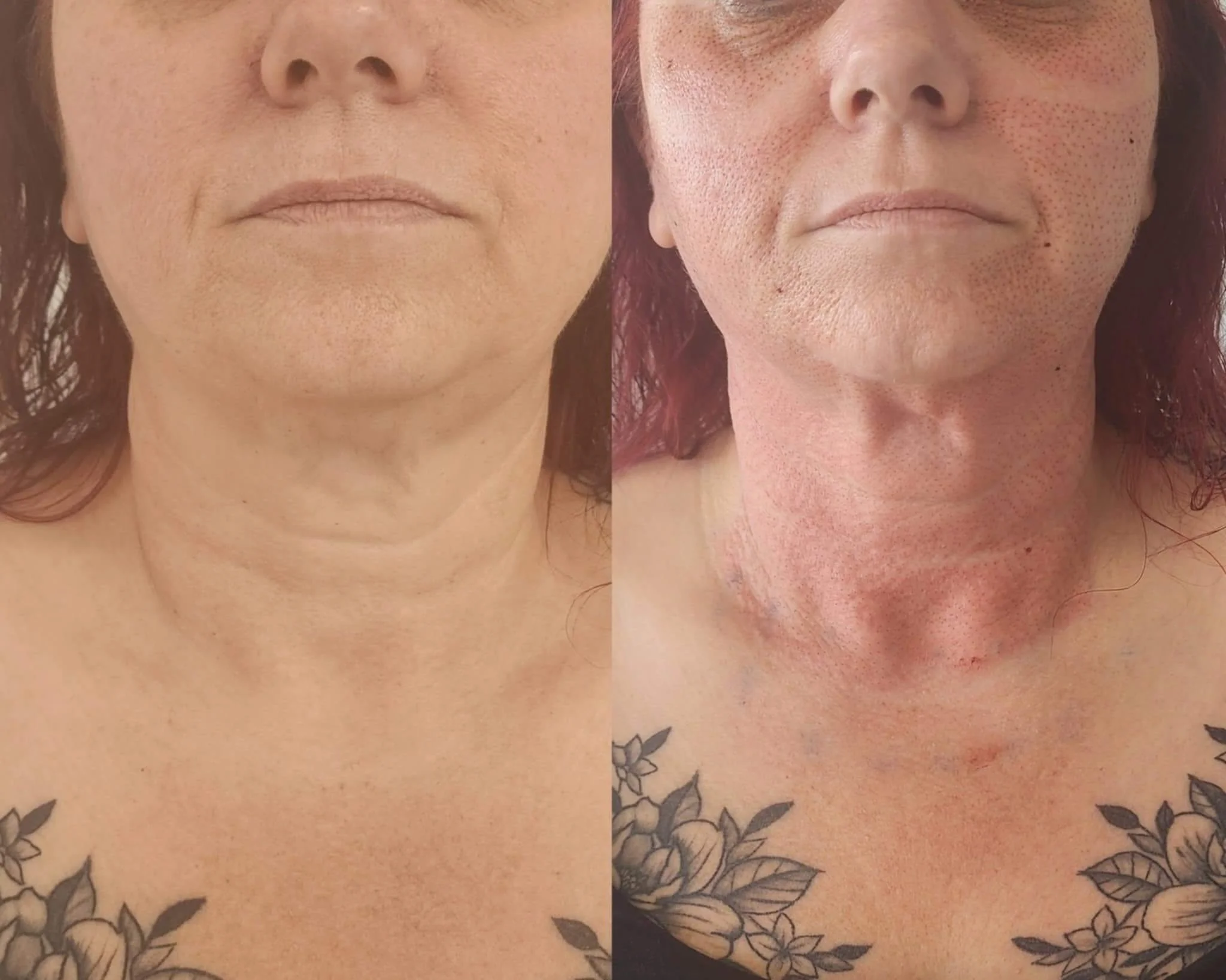 Fibroblast necklift results immediately after.