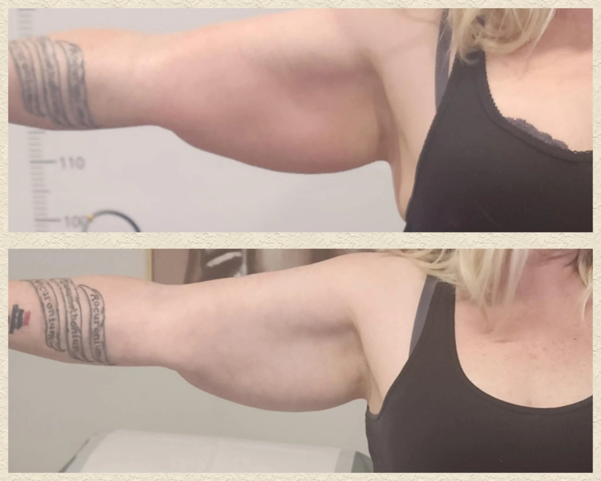After one coolsculpting session - size reduced - ready for next session.