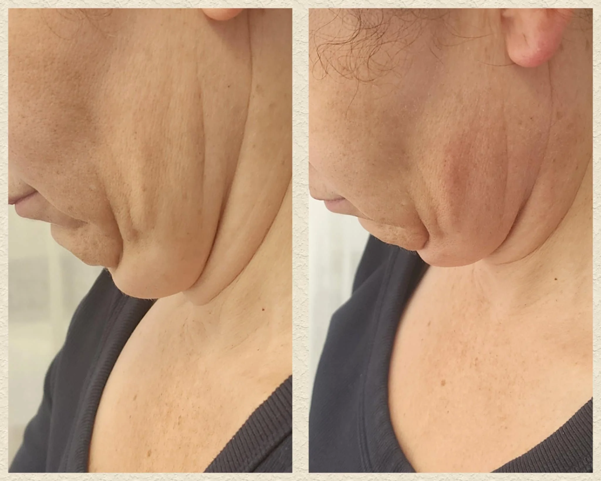Liquid lipo fat reduction after 1 treatment