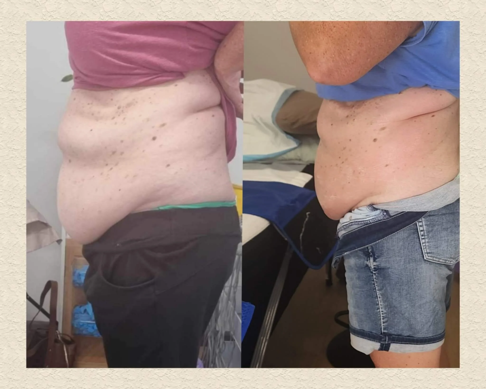 After a package of 5 liquid lipo treatments