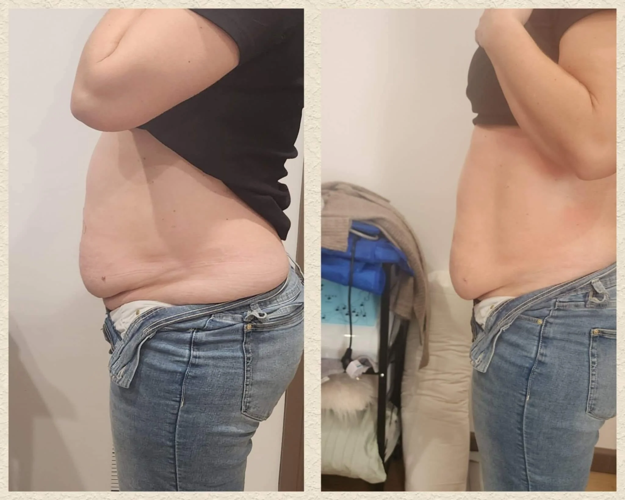 After 3 full tummy liquid lipo treatments