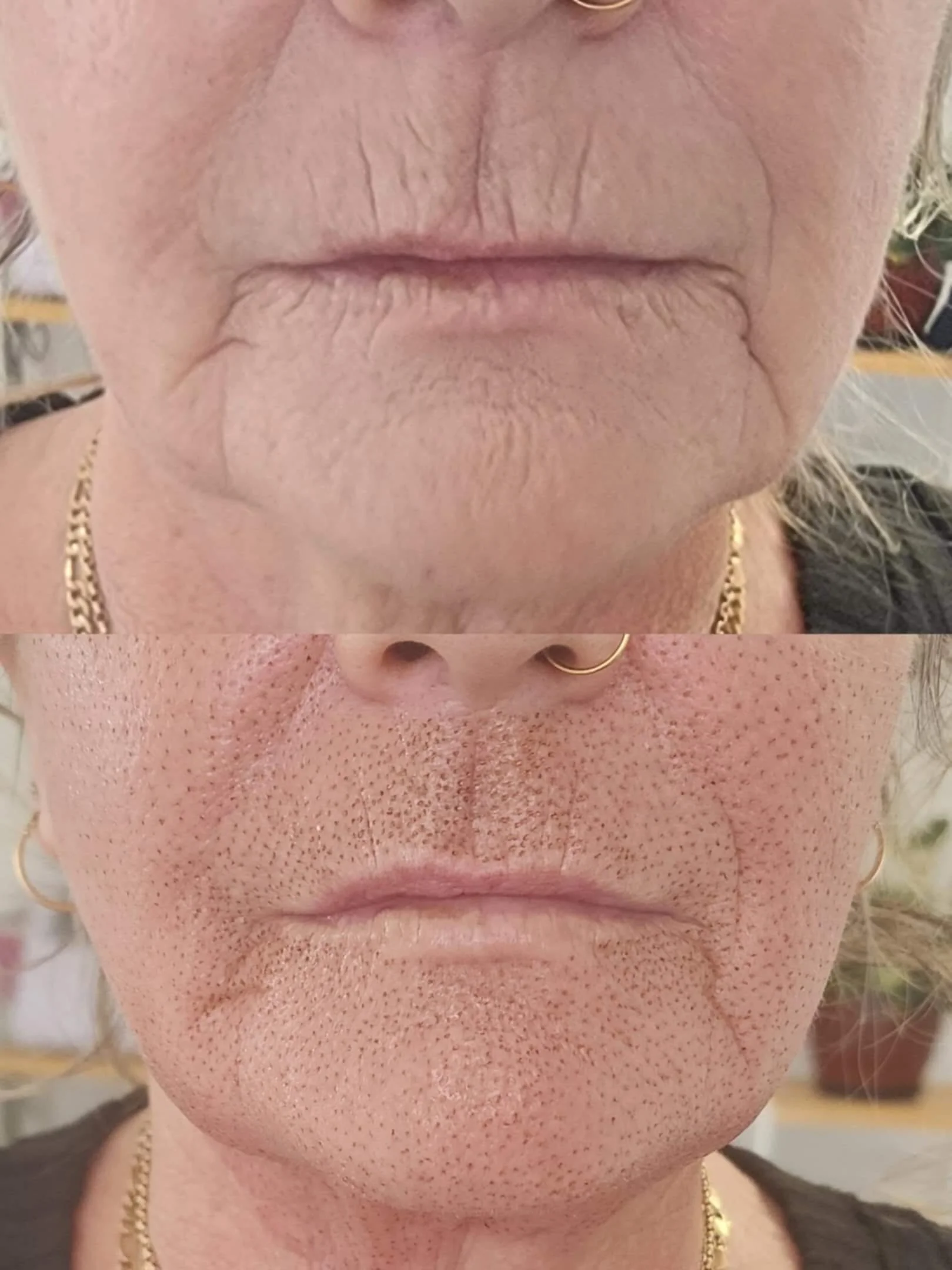 Half-face Fibroblast treatment (immediately after). Dots starts to come off after 5 days.