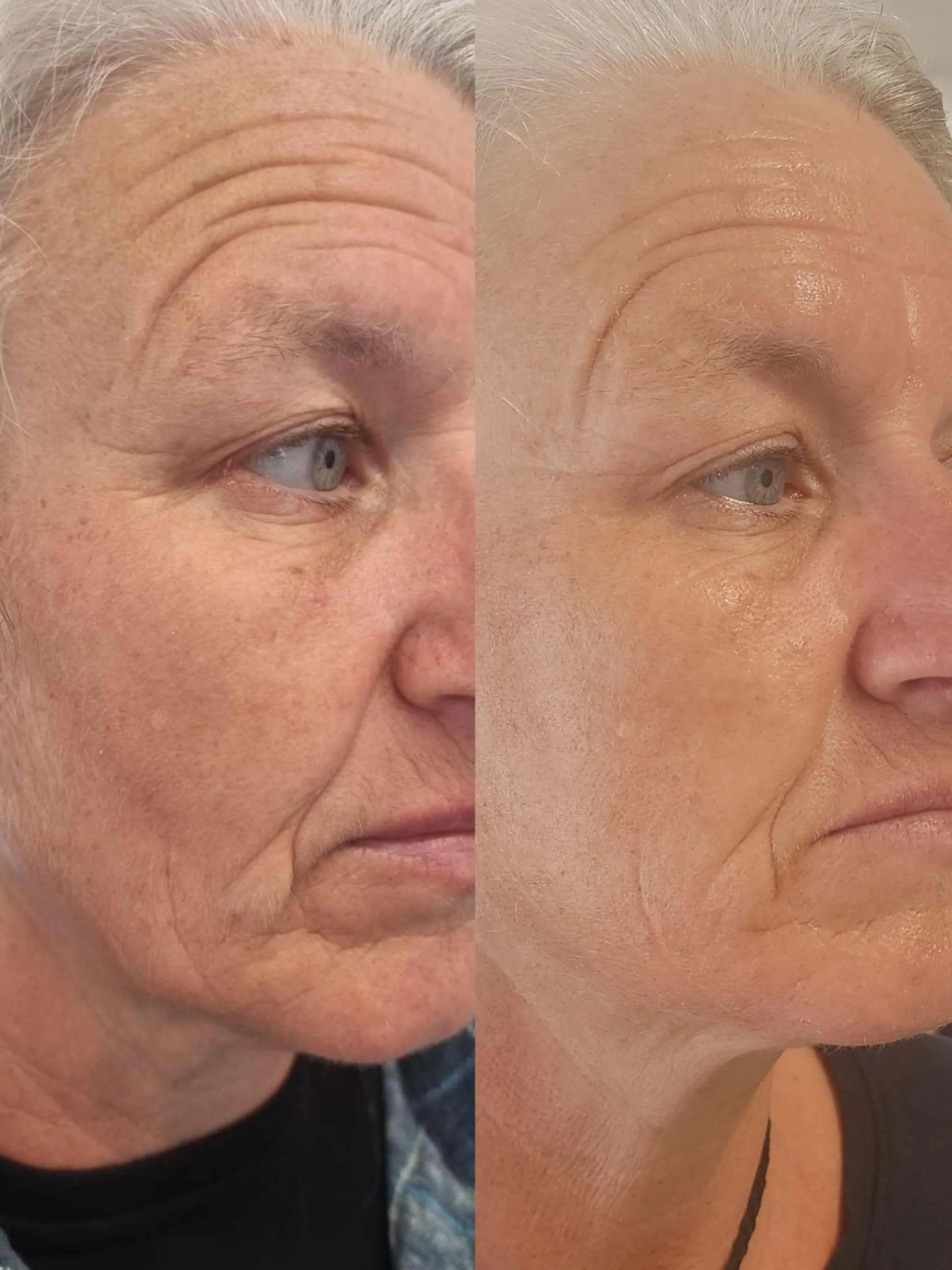 Full face fibroblast treatment