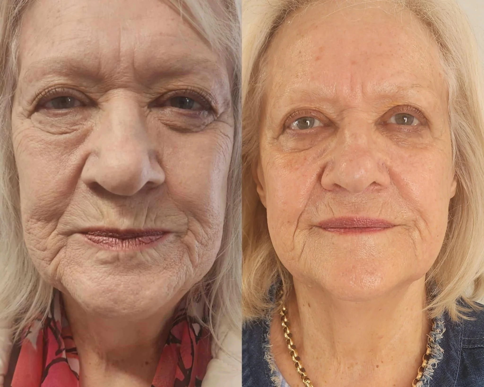 After 2 full face Fibroblast treatments