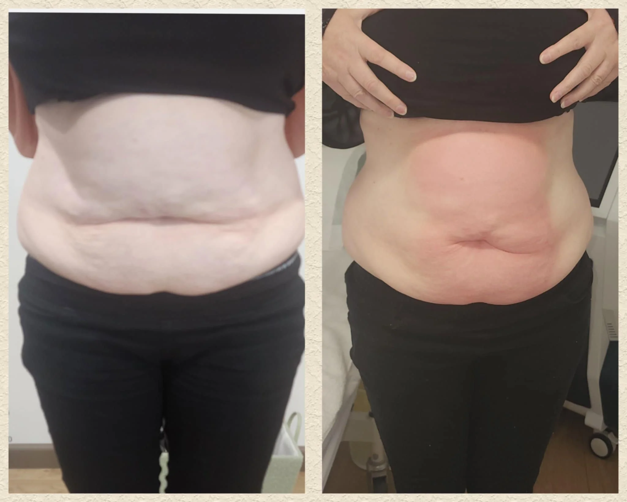 After a package of 5 coolsculpting sessions.