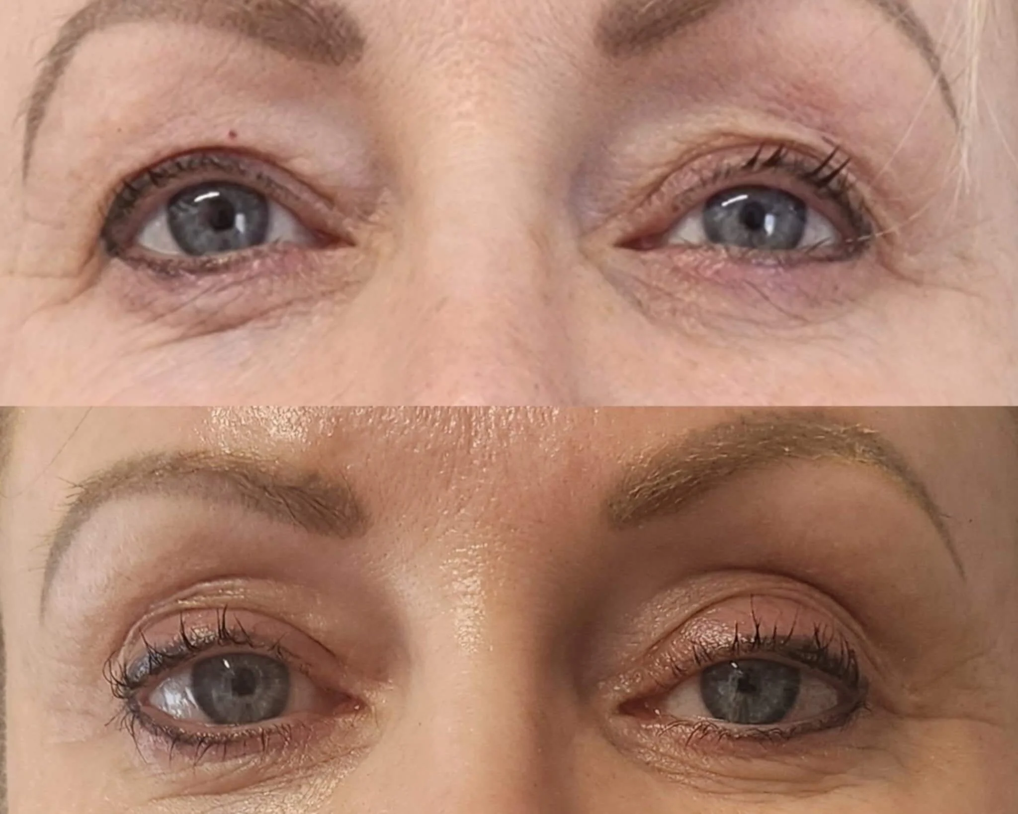 Upper eyelids - After two fibroblast treatments