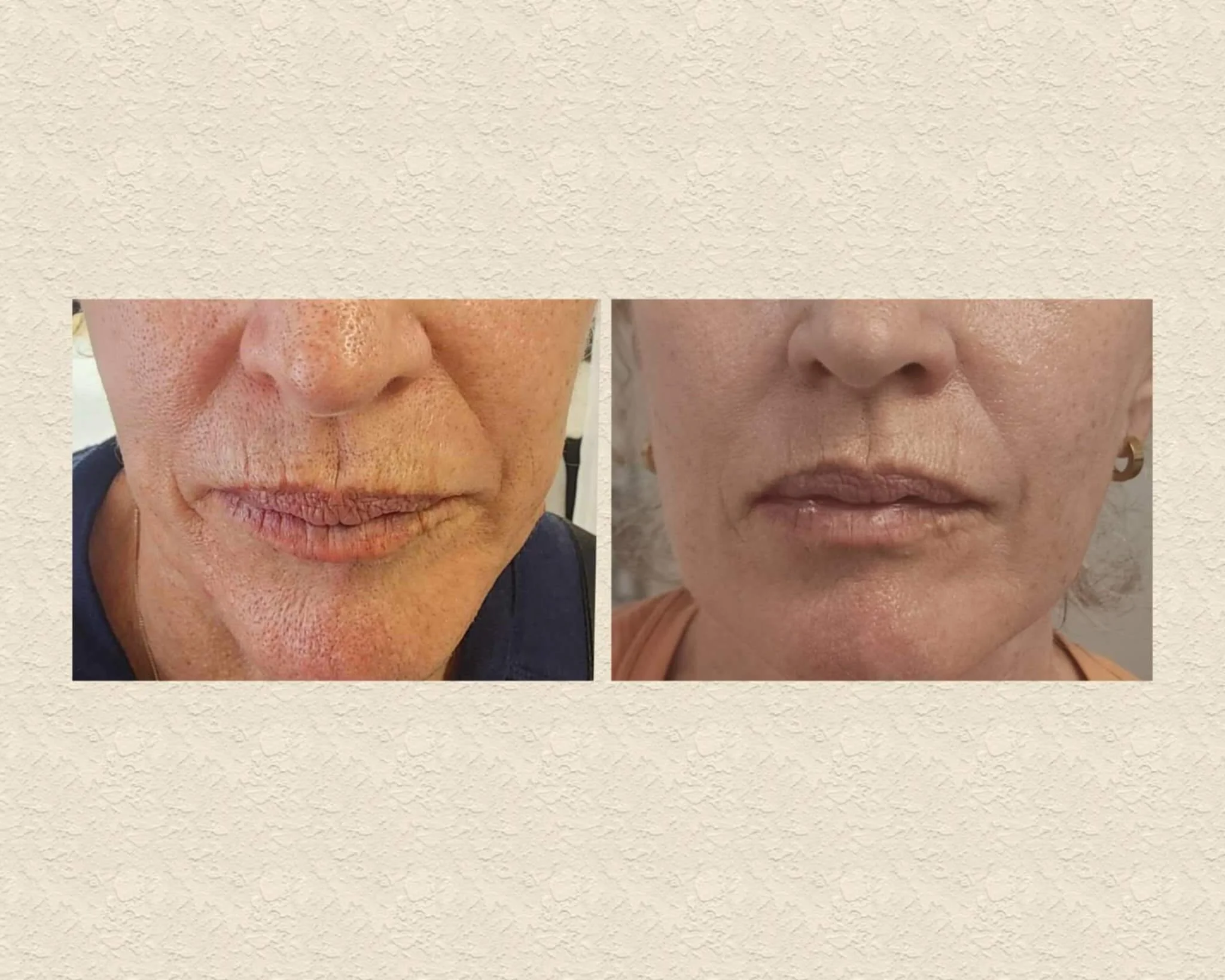 Results from a full face Fibroblast treatment. Lifting and tightening around lower face.