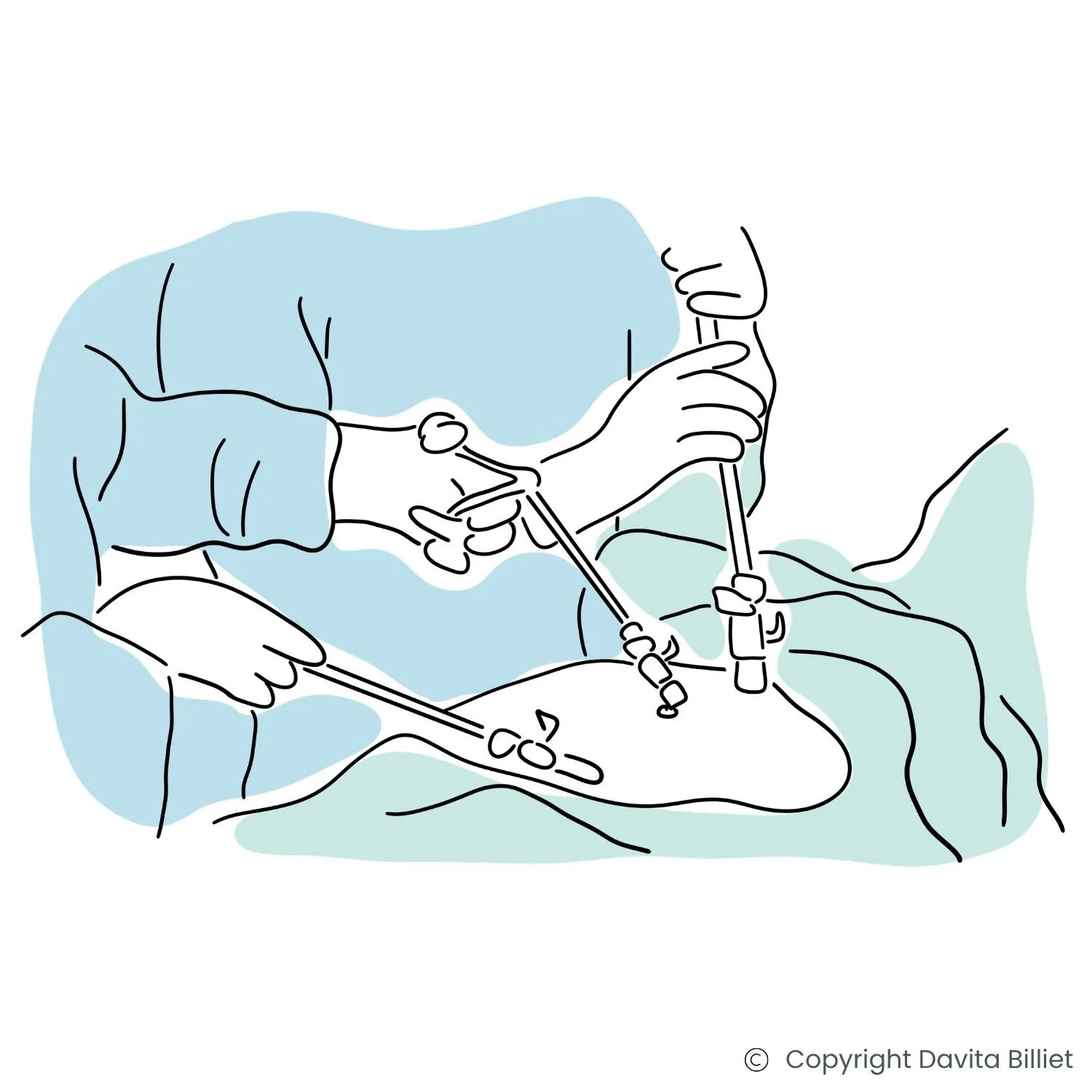 Illustration einer Bauchspiegelung (Laparoskopie) zur Diagnostik und Behandlung von Endometriose.