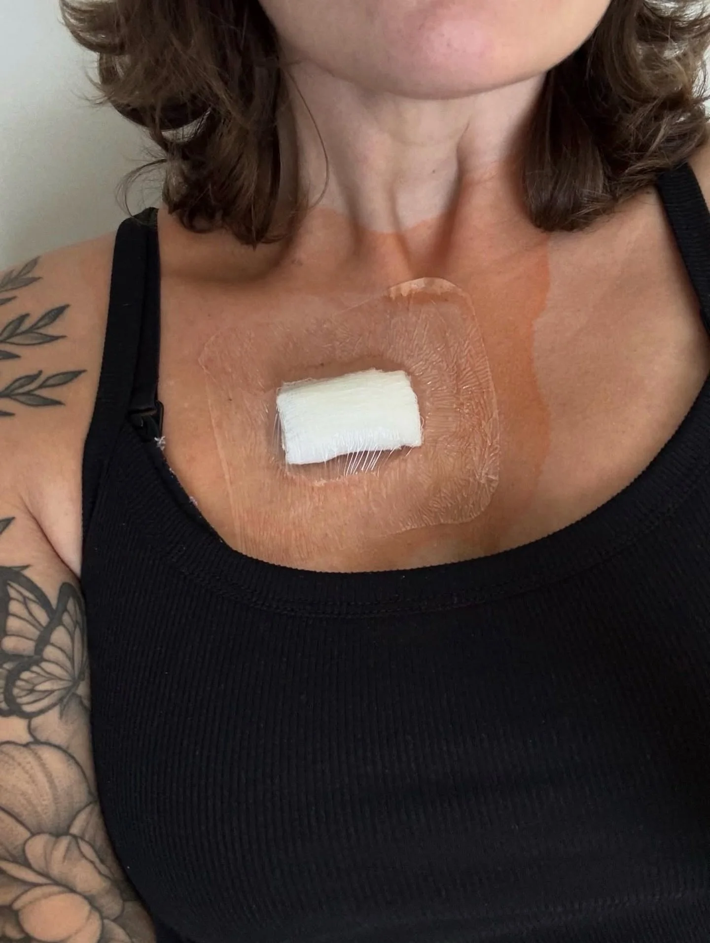 Today I said goodbye to my chemo port - @thee_royal_courtt 💕

A small device that carried me through one of the hardest journeys of my life. Removing it feels like closing a chapter.

One step closer to healing. One step further from cancer 🫶

#tnb