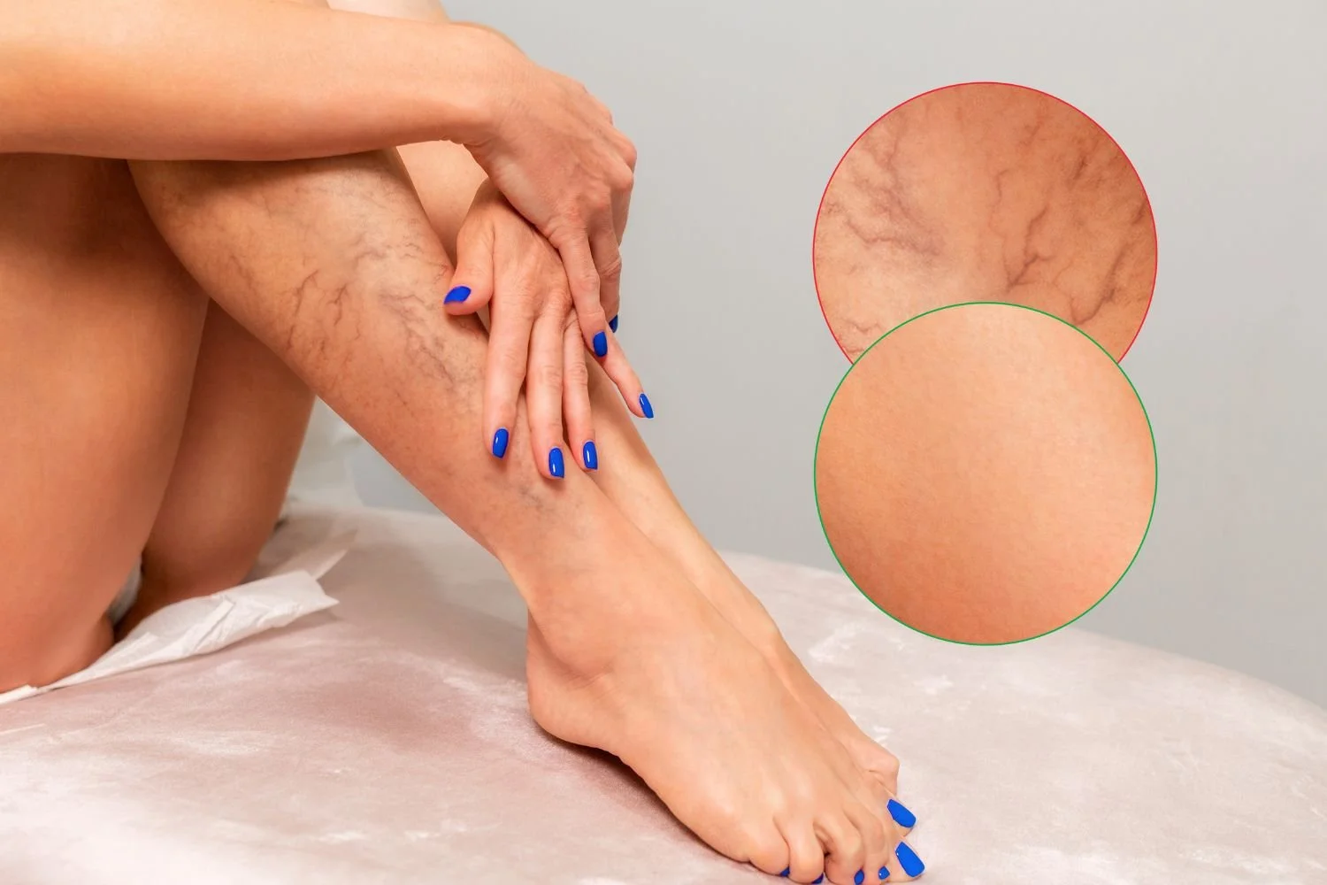 Vein Removal Package Deals