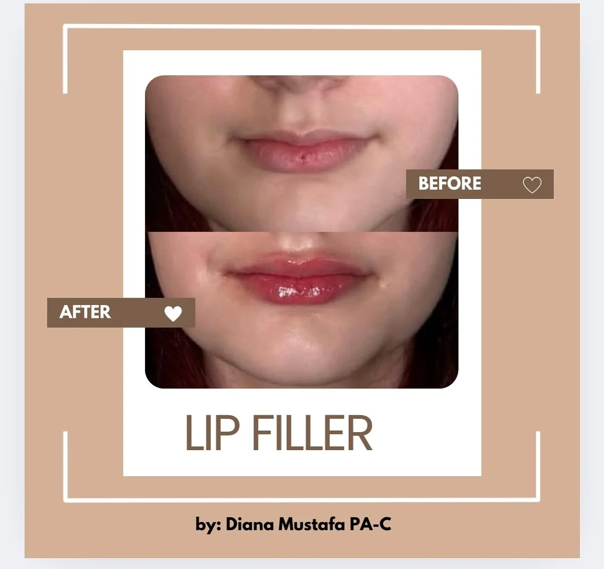 A little volume, a lot of confidence. 💋

Beautifully balanced, natural-looking results by Diana Mustafa, PA-C at Mira Med Spa.

✨ Subtle enhancement. Soft, hydrated finish. Confident glow.

📞 Call or text 813-654-6472 to book your consultation.

#M