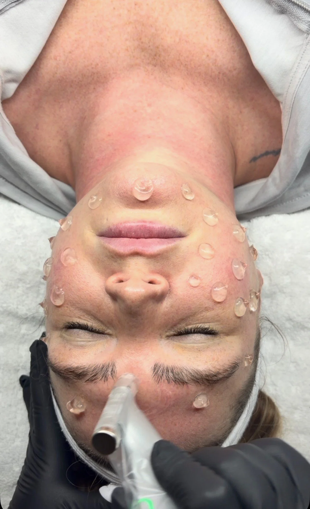 Microneedling with Botox: The Perfect Duo for Natural, Radiant Results