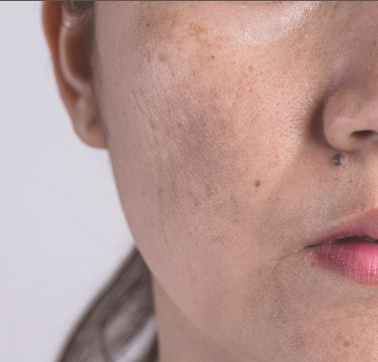 Sun damage, brown spots, pigmentation, aging skin