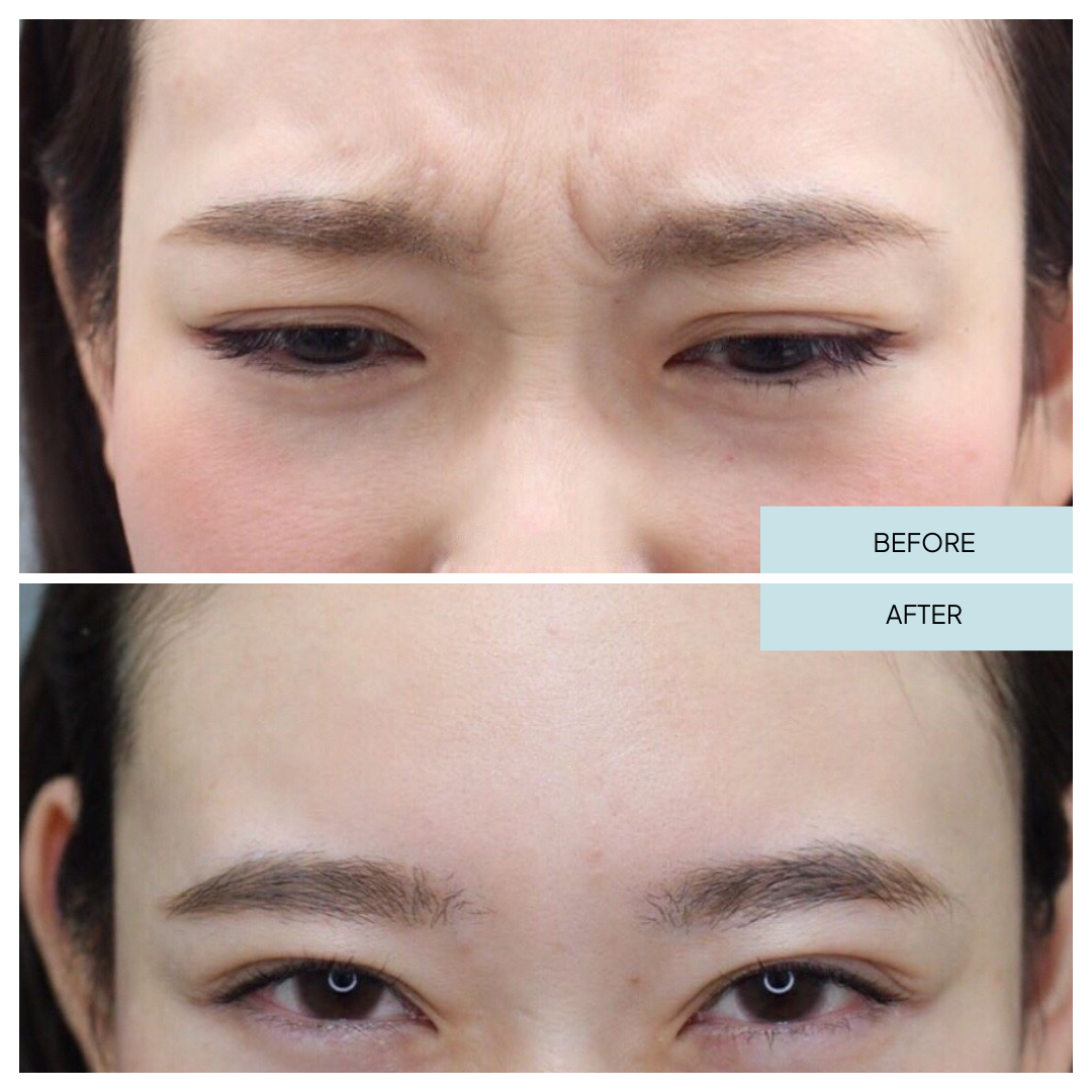 Before & After - Brow Lift