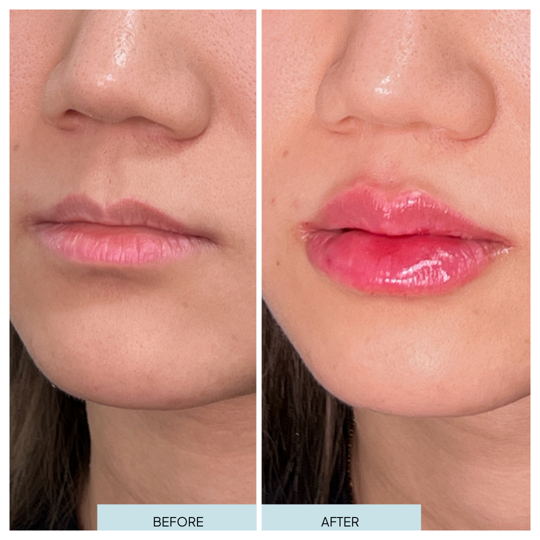 Lip Filler _ Arlington, VA (7).png