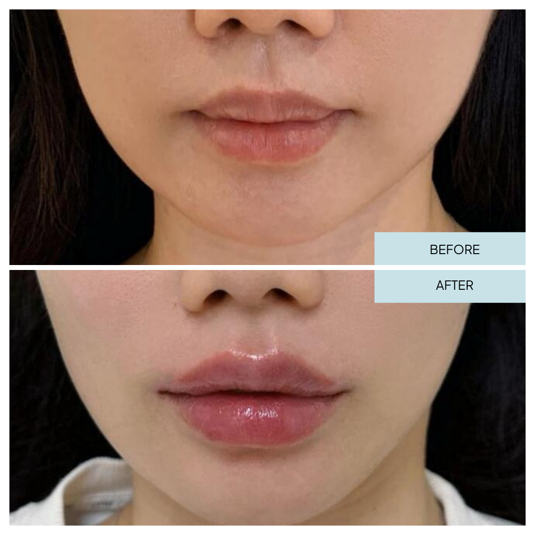 Lip Filler _ Arlington, VA (4).png