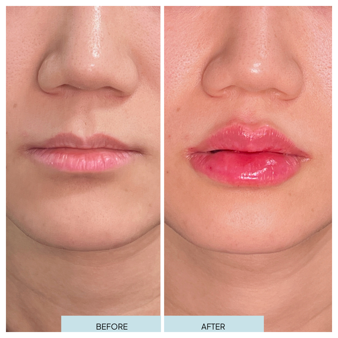 Lip Filler _ Arlington, VA (6).png