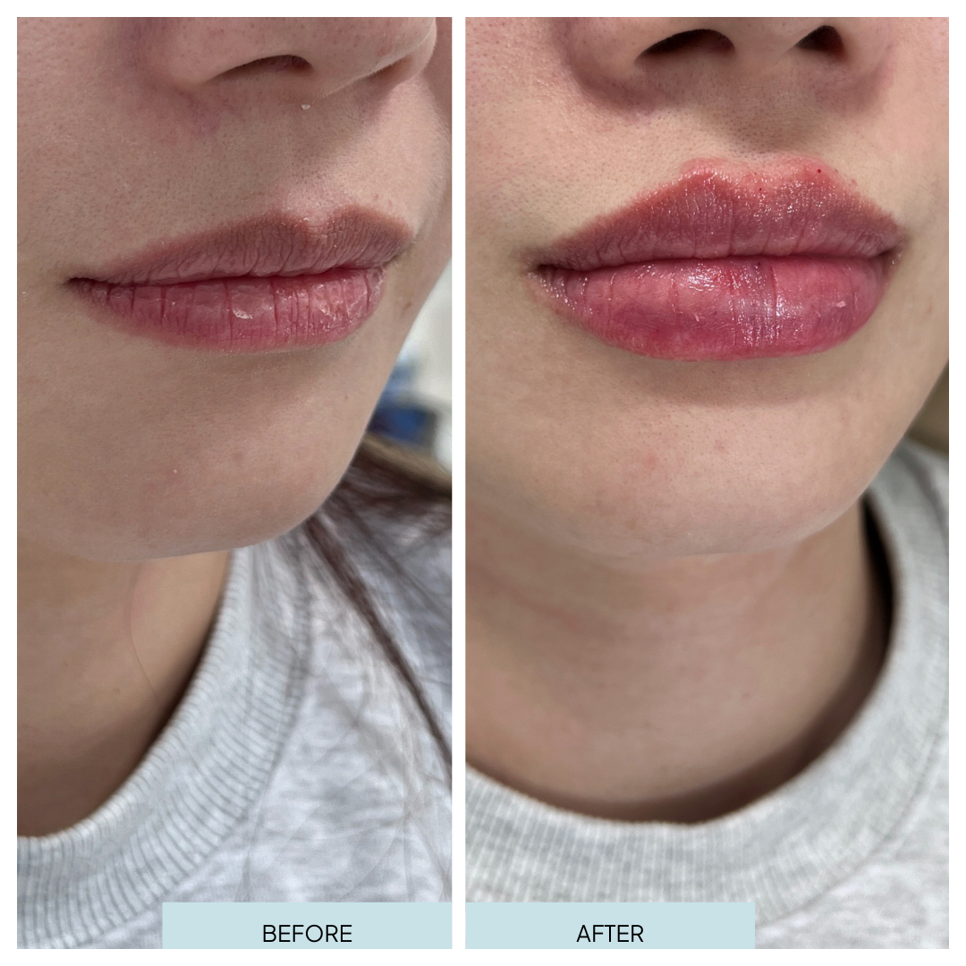 Lip Filler _ Arlington, VA (10).png