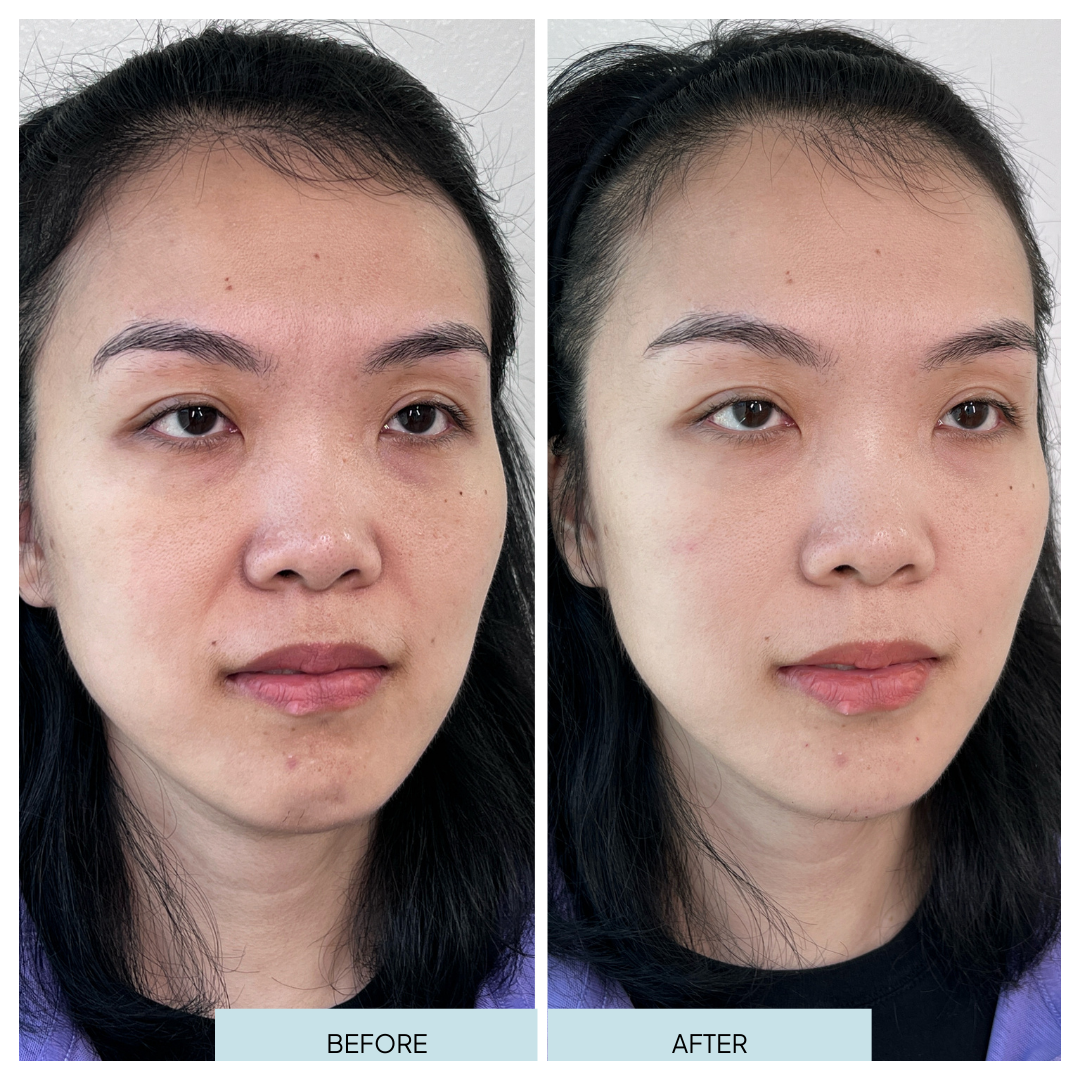 Full Face Rejuvenation with Filler _ Arlington, VA (4).png