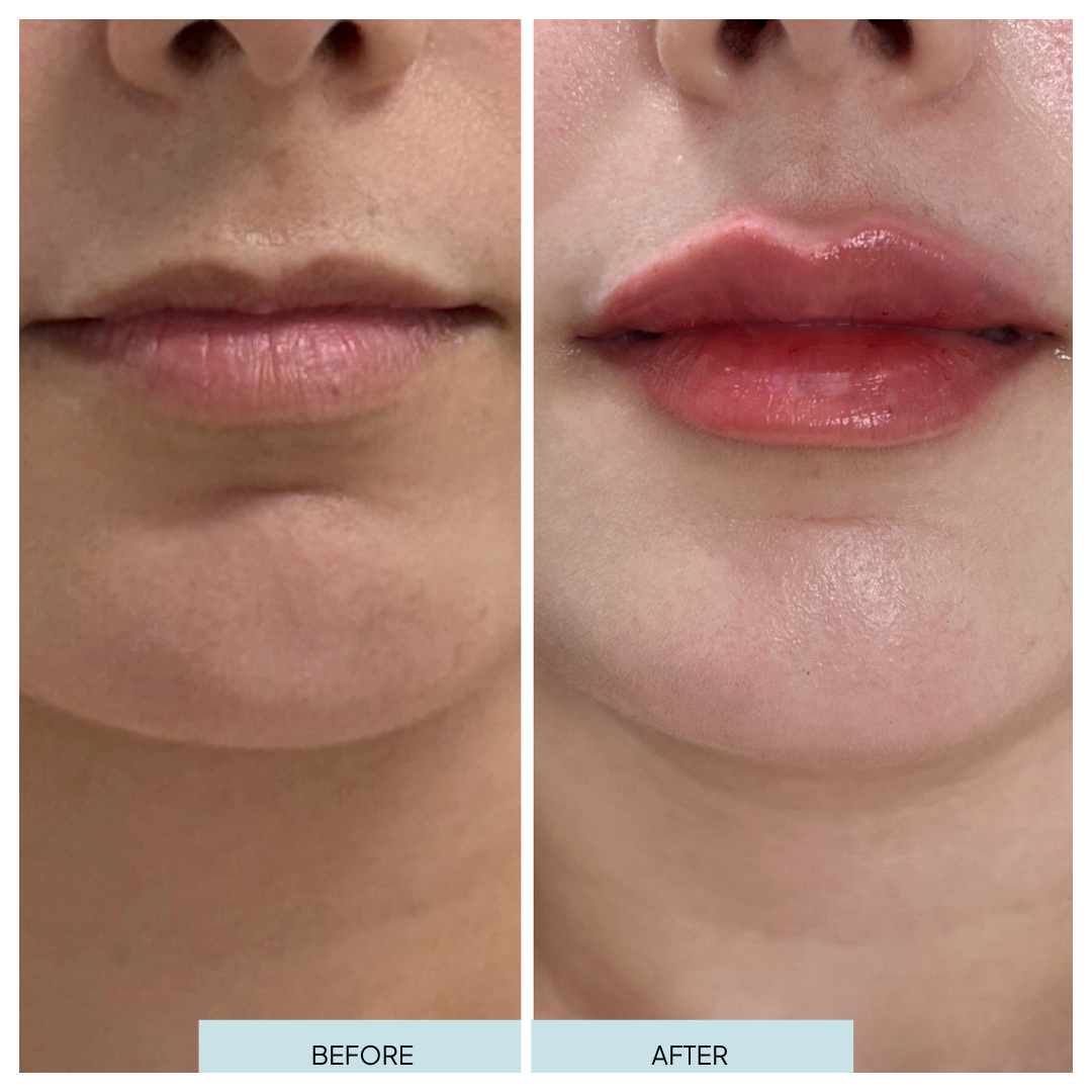 Lip Filler _ Arlington, VA (3).png