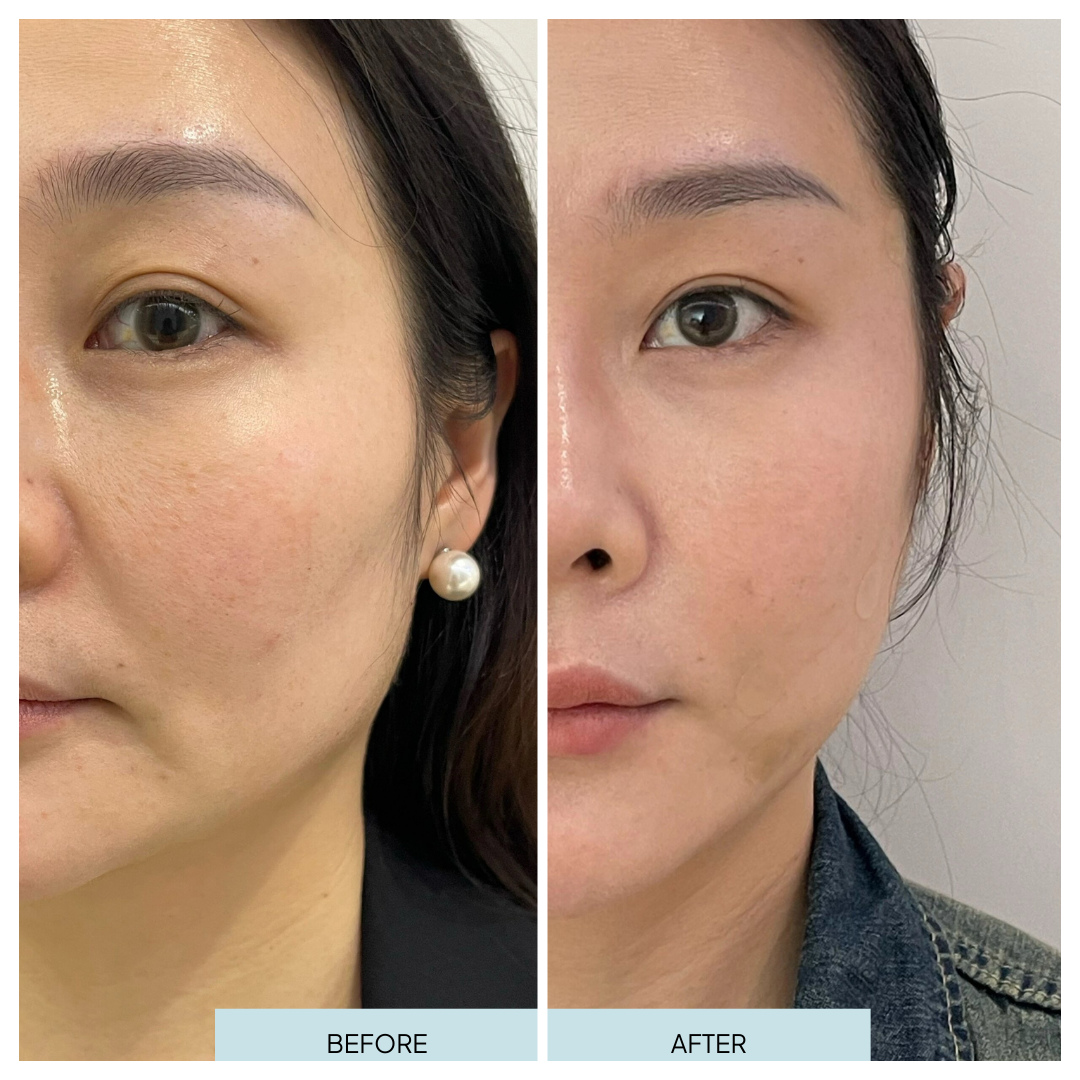 Full Face Rejuvenation with Filler  _ Arlington, VA.png