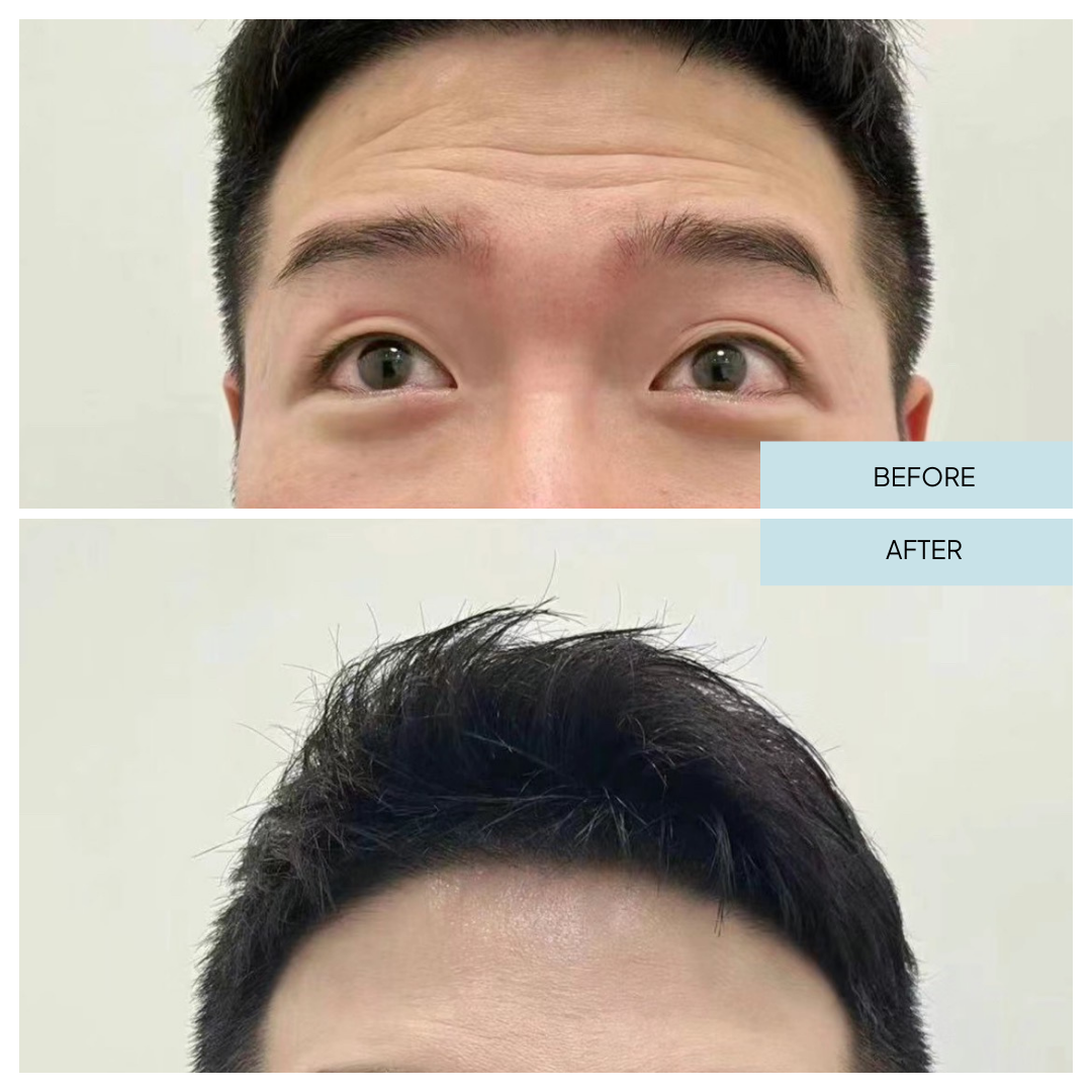 Forehead Lines with Botox in Arlington, VA