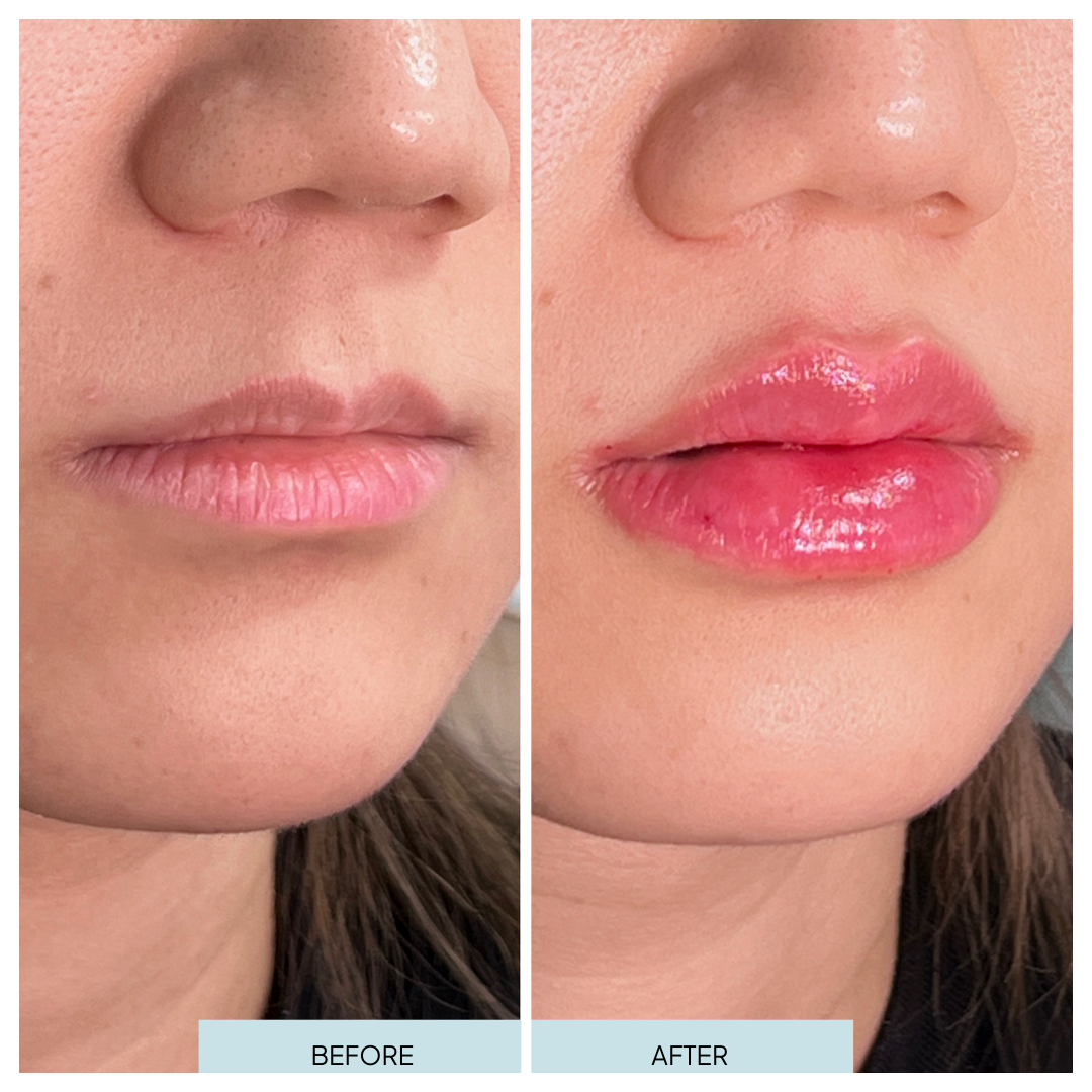 Lip Filler _ Arlington, VA (5).png