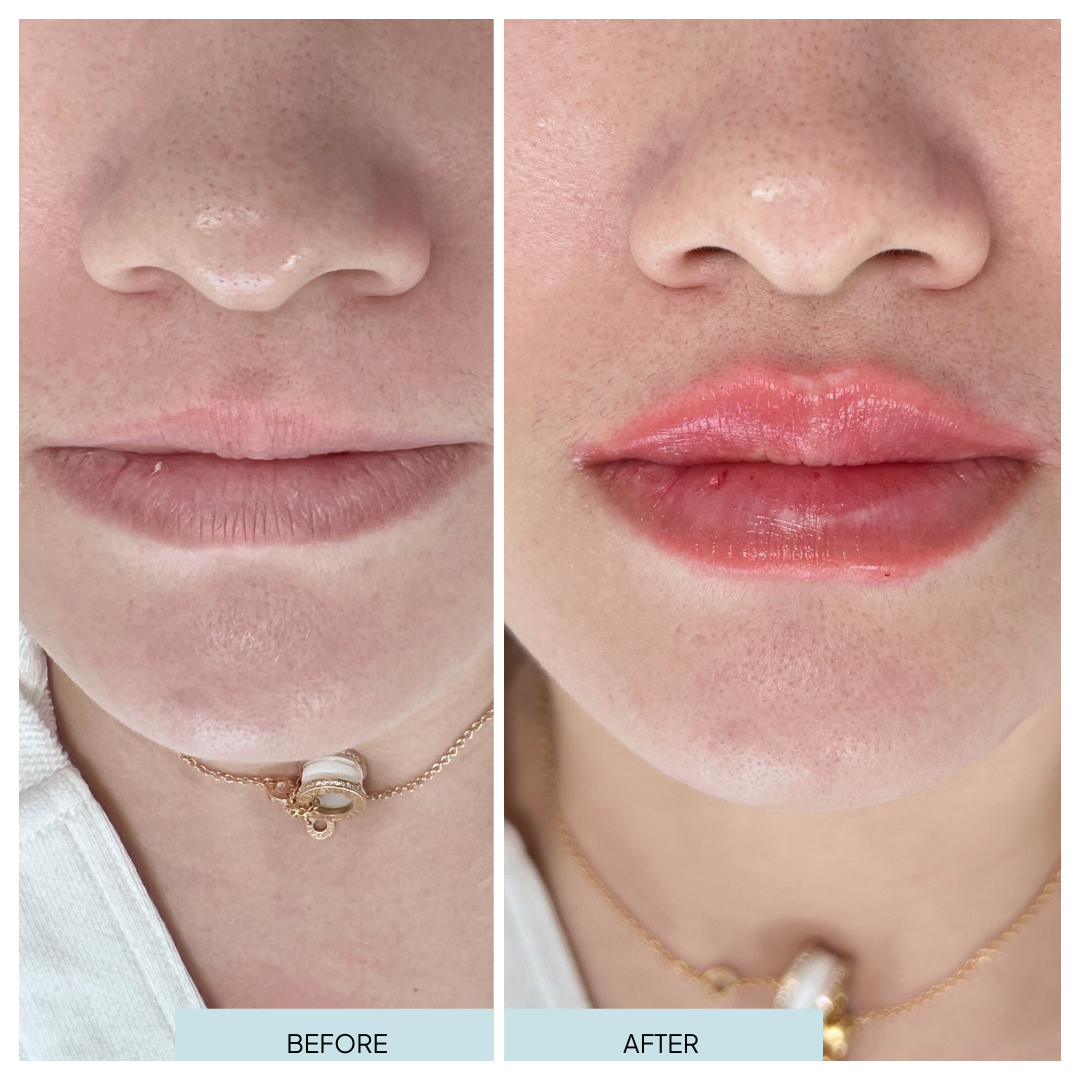 Lip Filler _ Arlington, VA (2).png